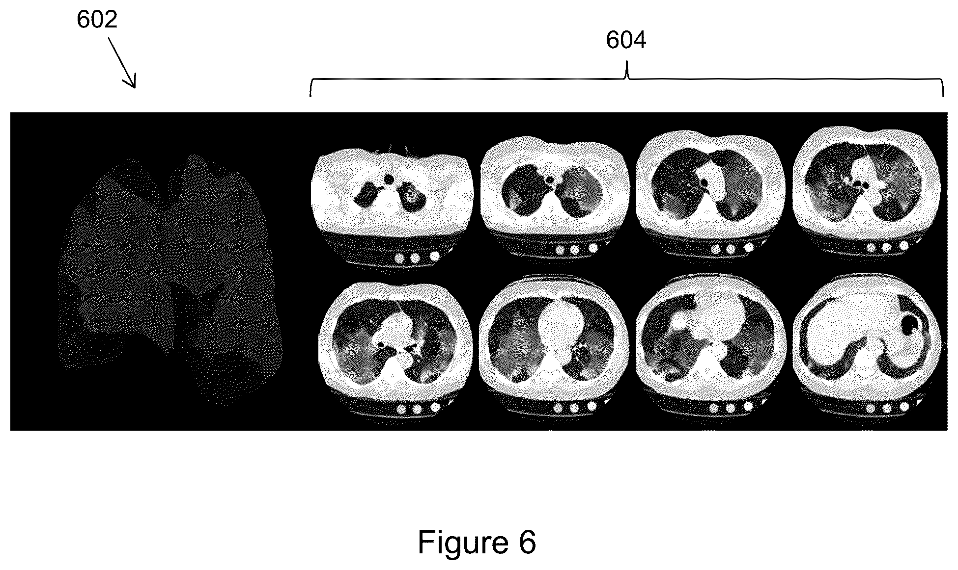 Patent US11810291 Figure 6 – Medical image synthesis of abnormality patterns associated with COVID-19