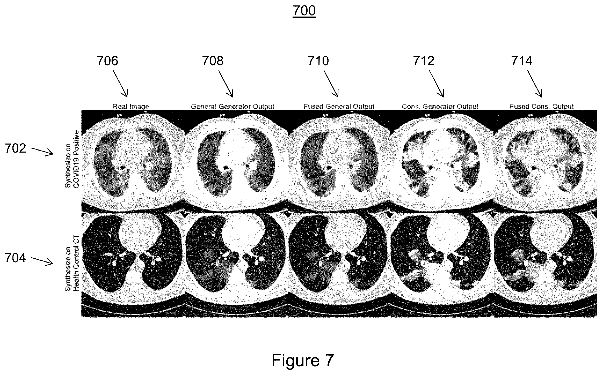 Patent US11810291 Figure 7 – Medical image synthesis of abnormality patterns associated with COVID-19