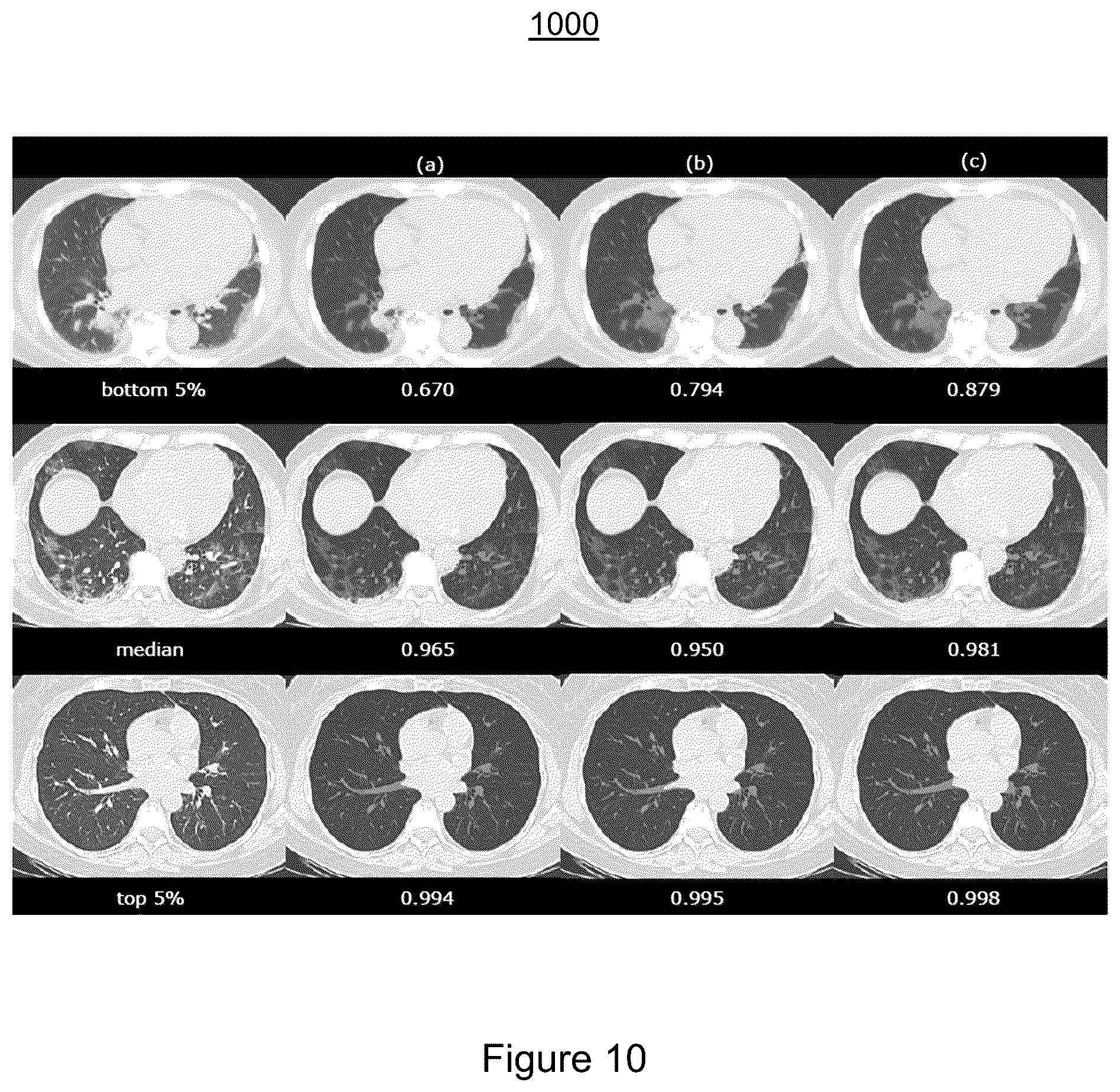 Patent US11810291 Figure 10 – Medical image synthesis of abnormality patterns associated with COVID-19