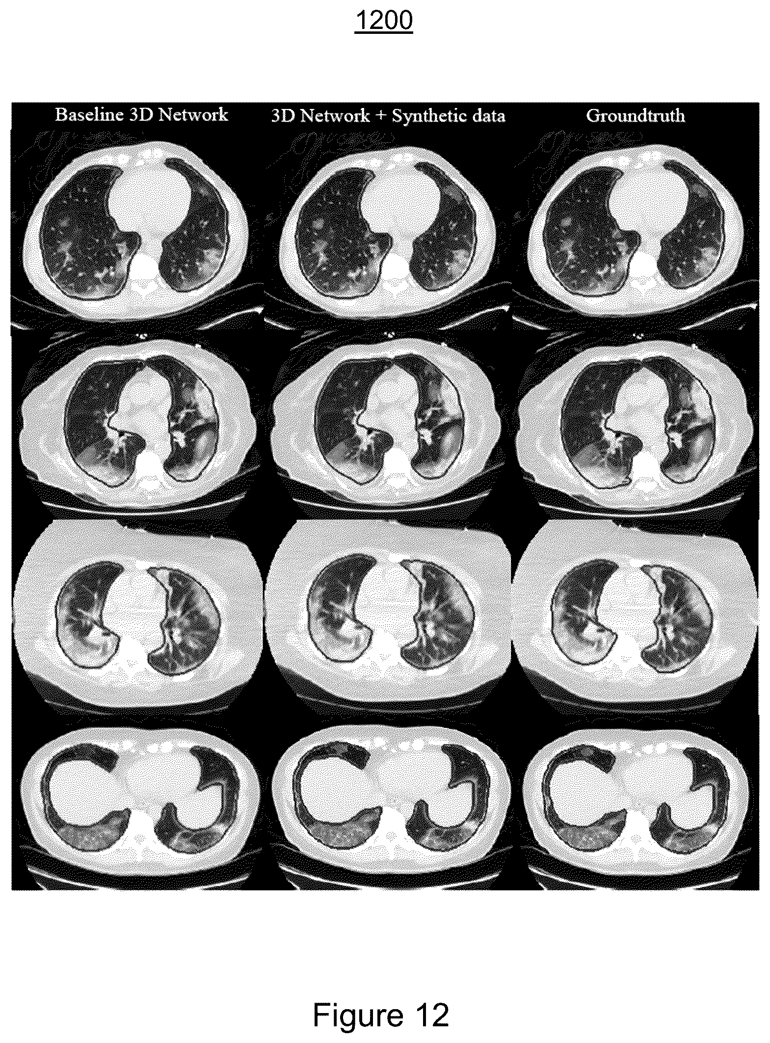 Patent US11810291 Figure 12 – Medical image synthesis of abnormality patterns associated with COVID-19