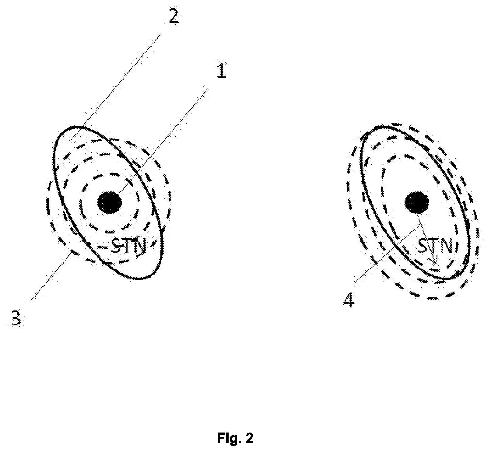 Patent US11810663 Figure 2 – Simulating a target coverage for deep brain stimulation