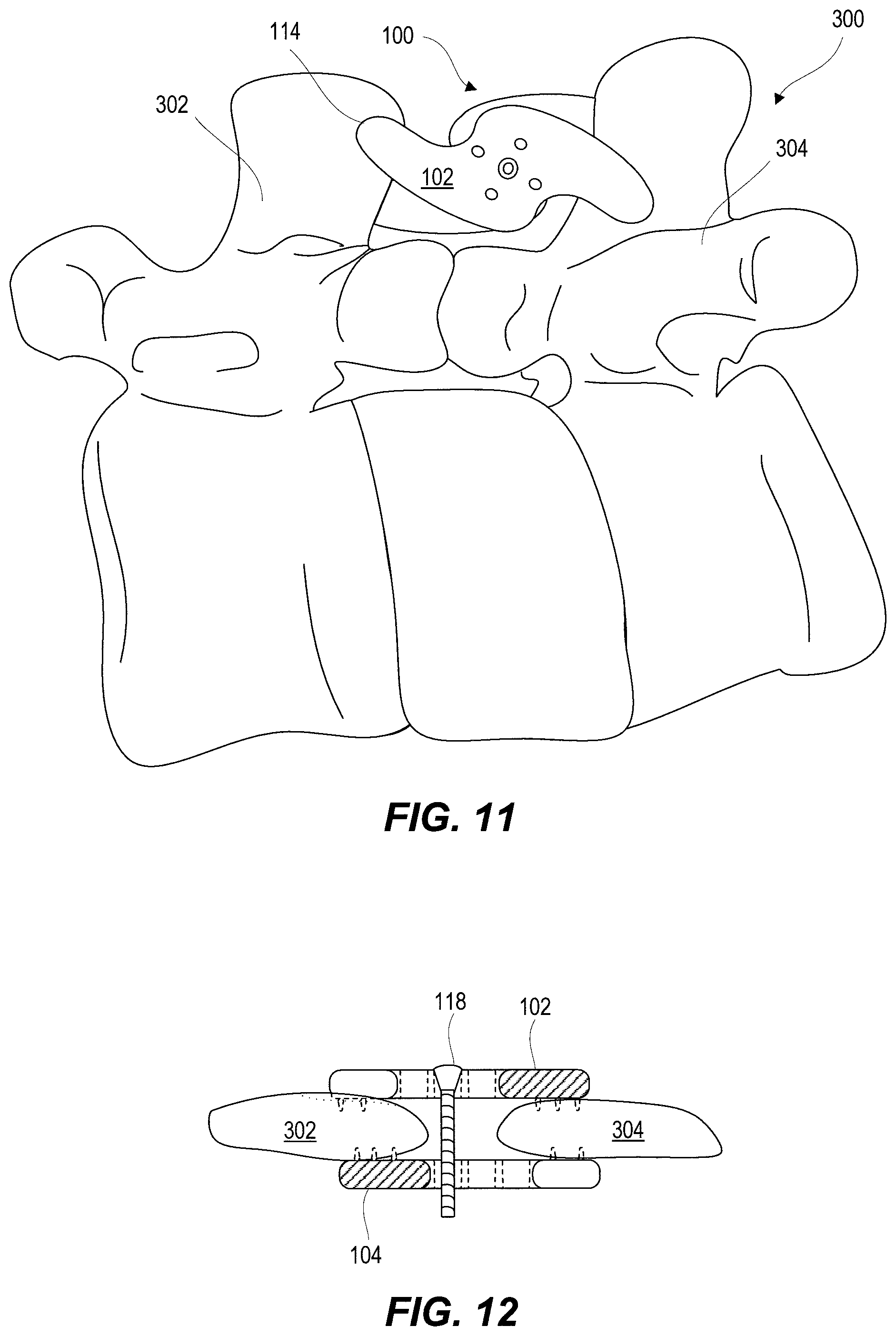 Patent US11812923 Figure 5 – Spinal fixation device