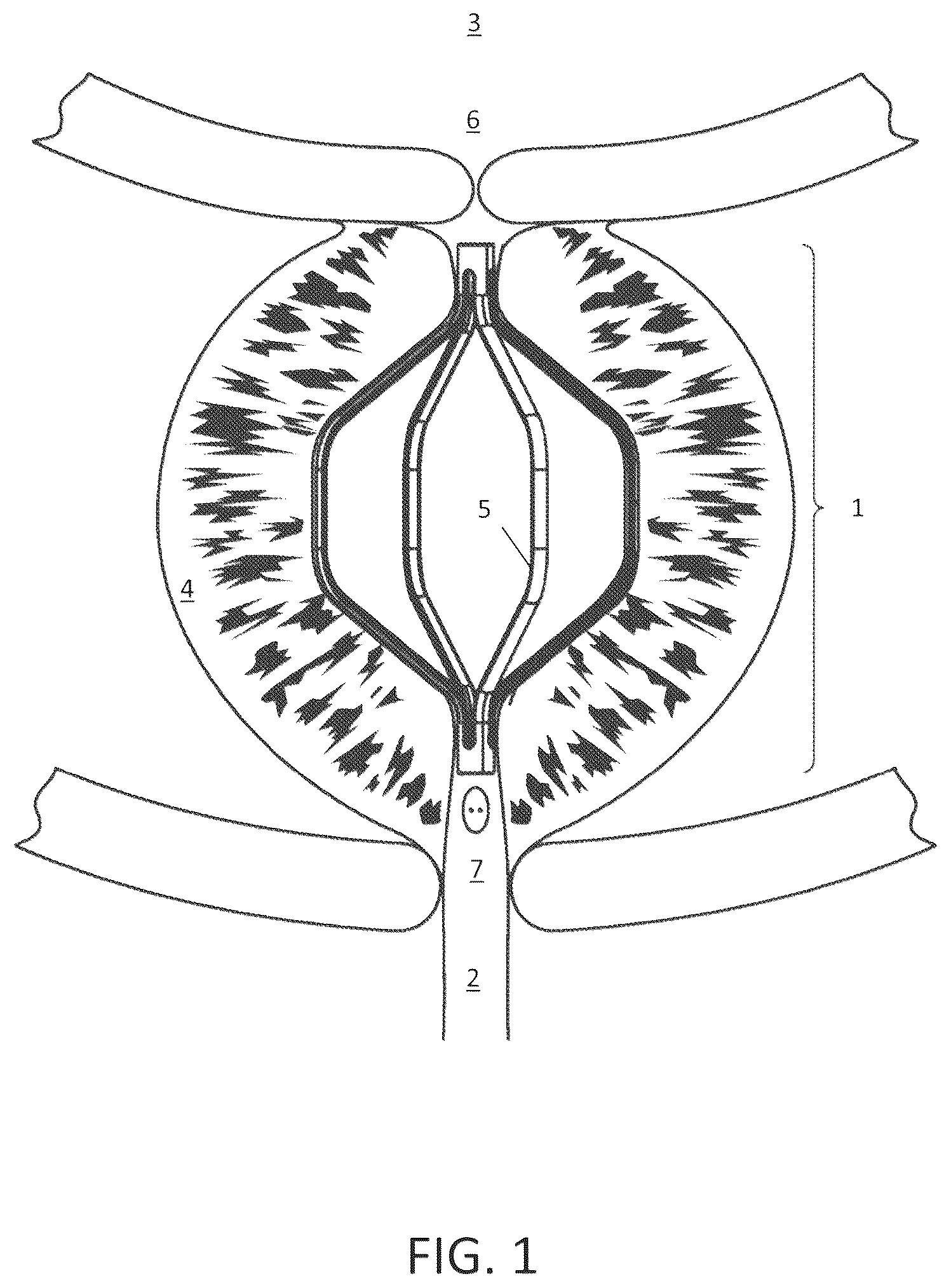 Patent US11812930 Figure 1 – Devices for the treatment of benign prostatic hyperplasia and related lower urinary tract symptoms