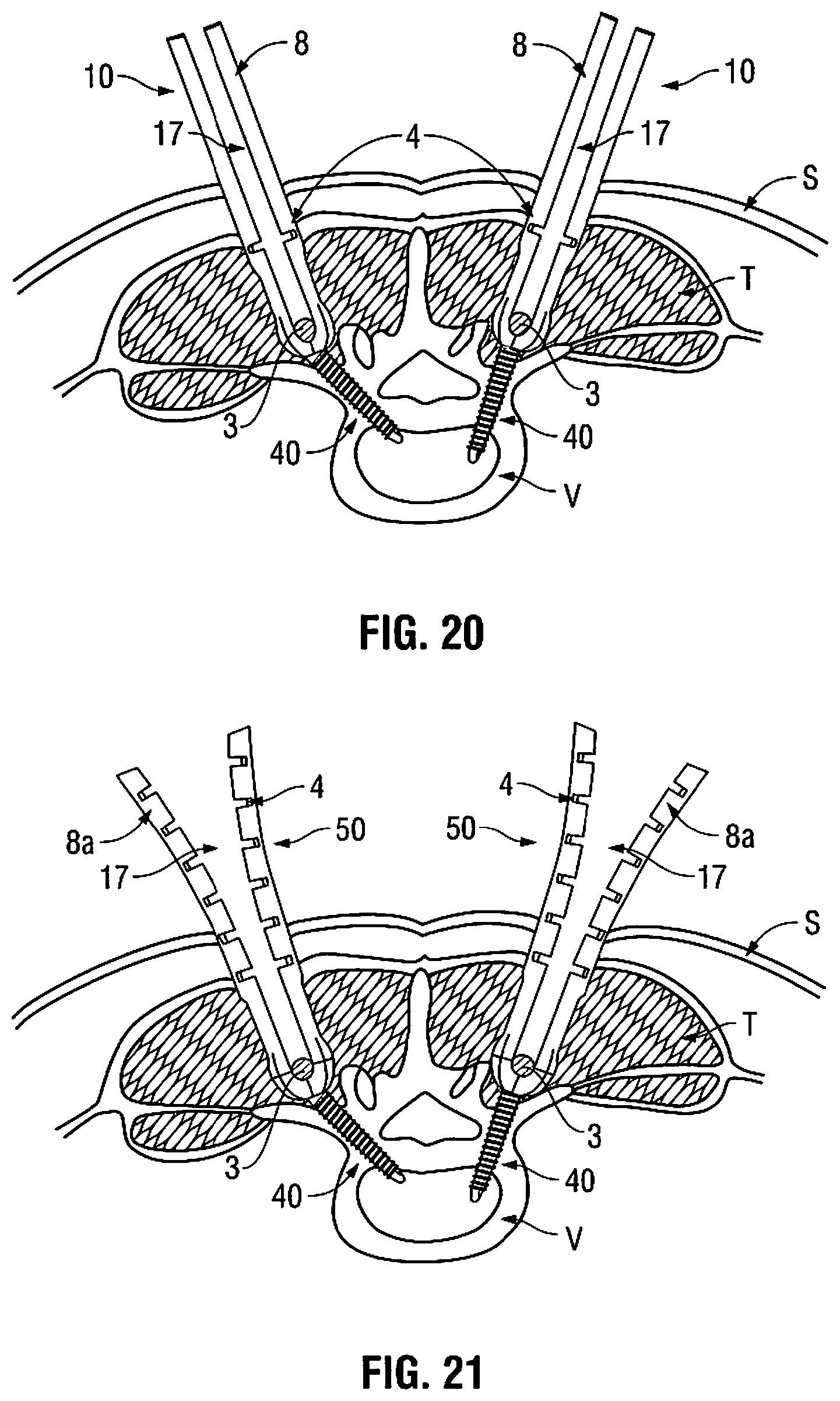Patent US11812940 Figure 18 – Minimally open interbody access retraction device and surgical method