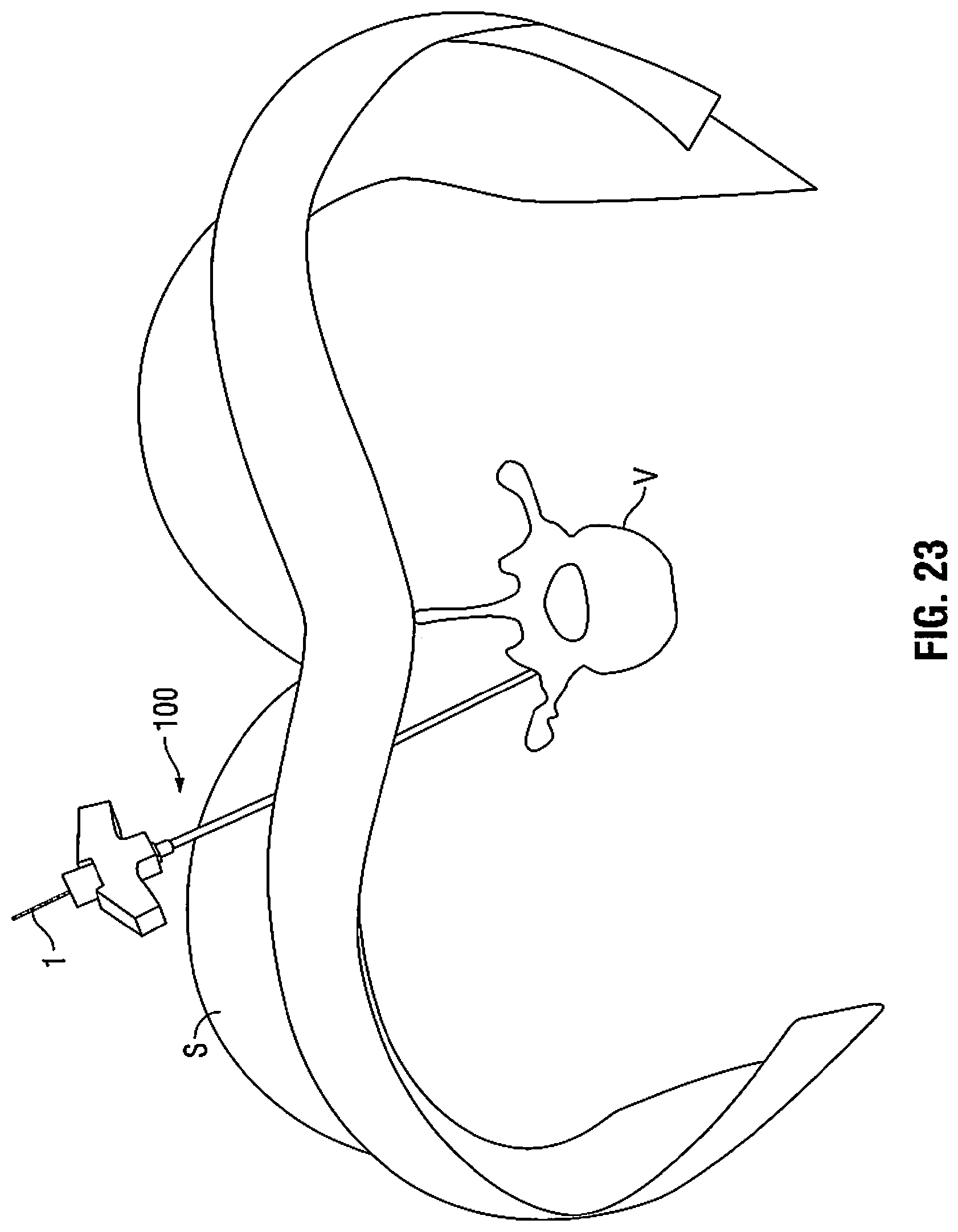 Patent US11812940 Figure 20 – Minimally open interbody access retraction device and surgical method