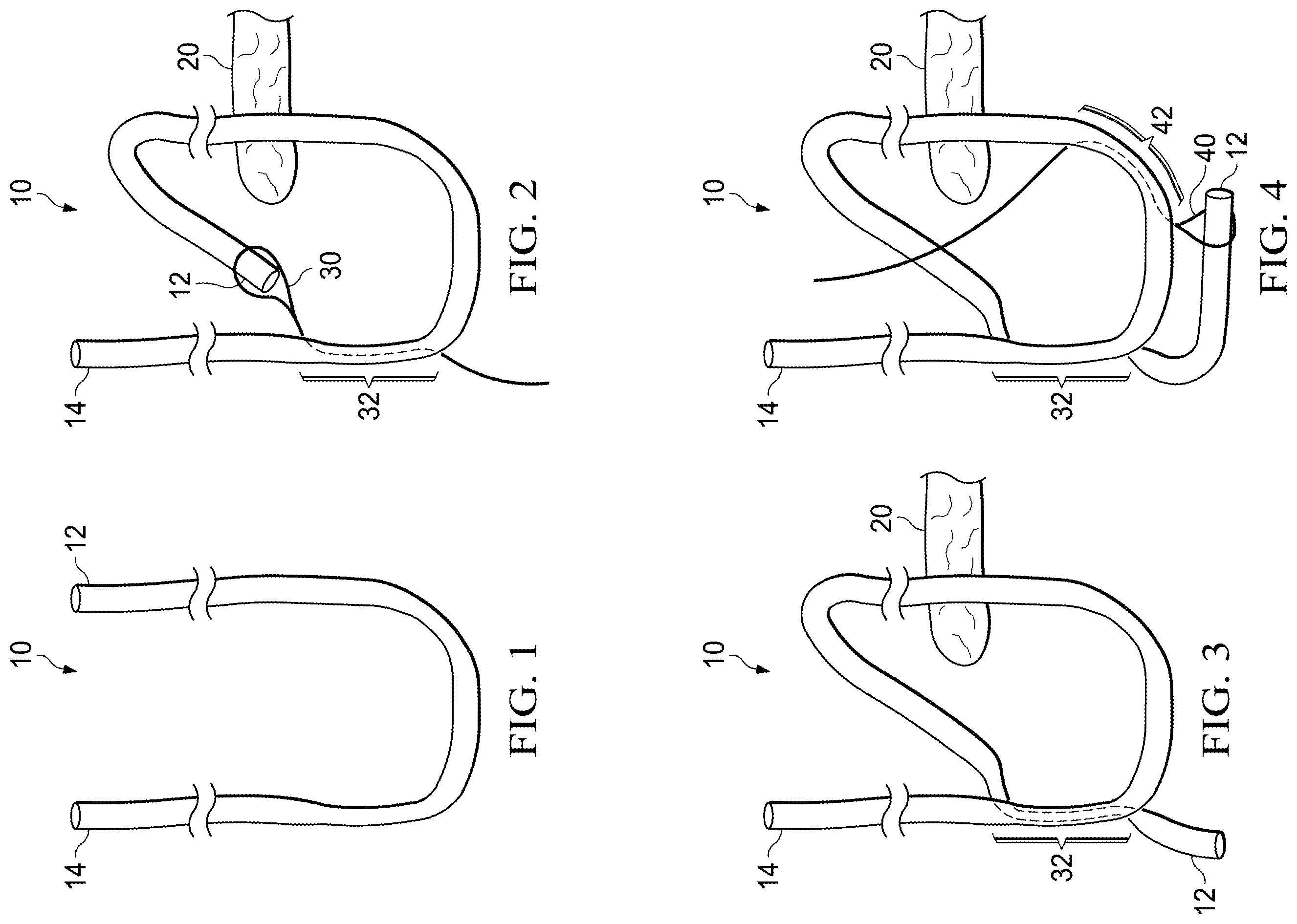 Patent US11812941 Figure 1 – Knotless all suture tissue repair