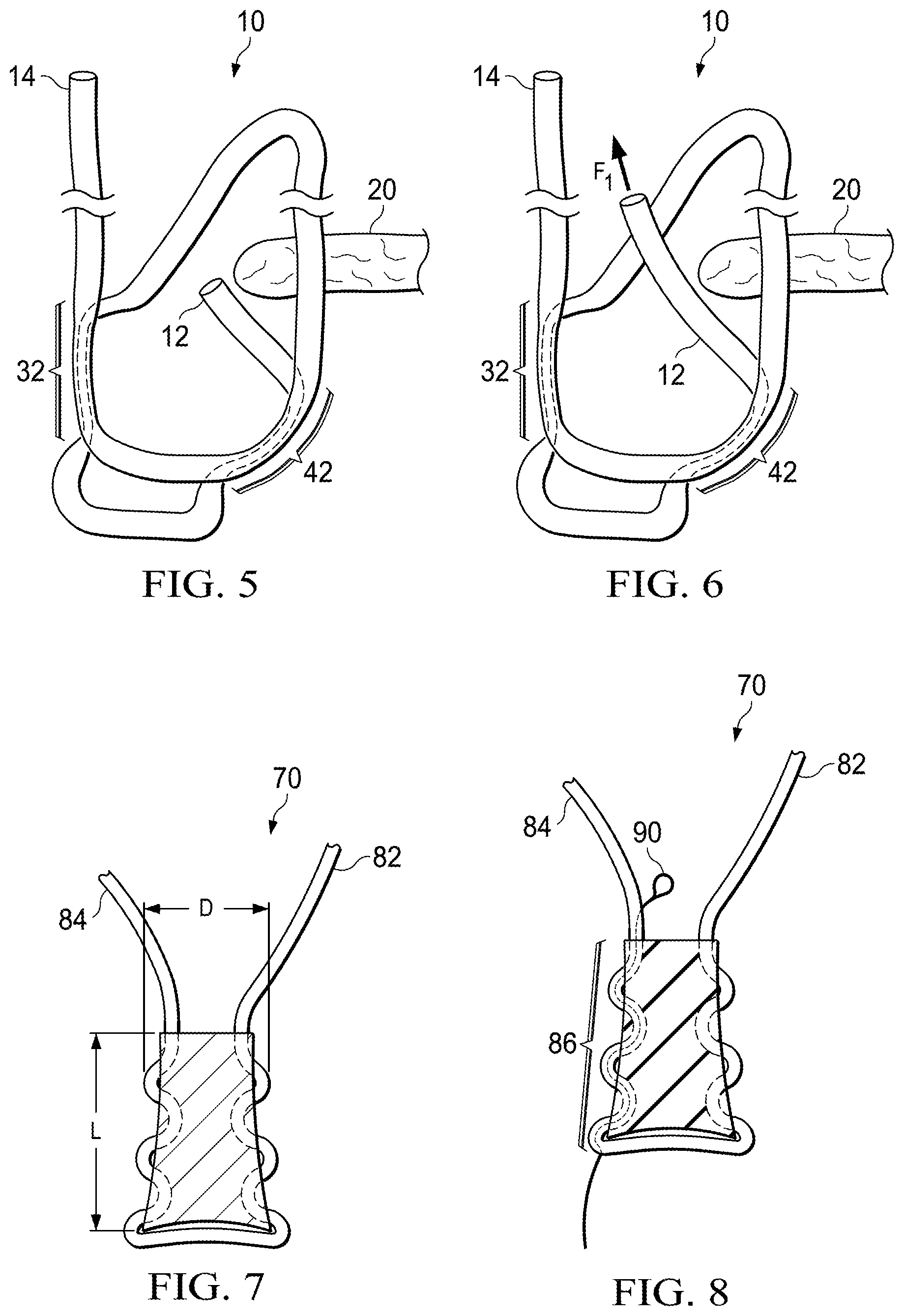 Patent US11812941 Figure 2 – Knotless all suture tissue repair
