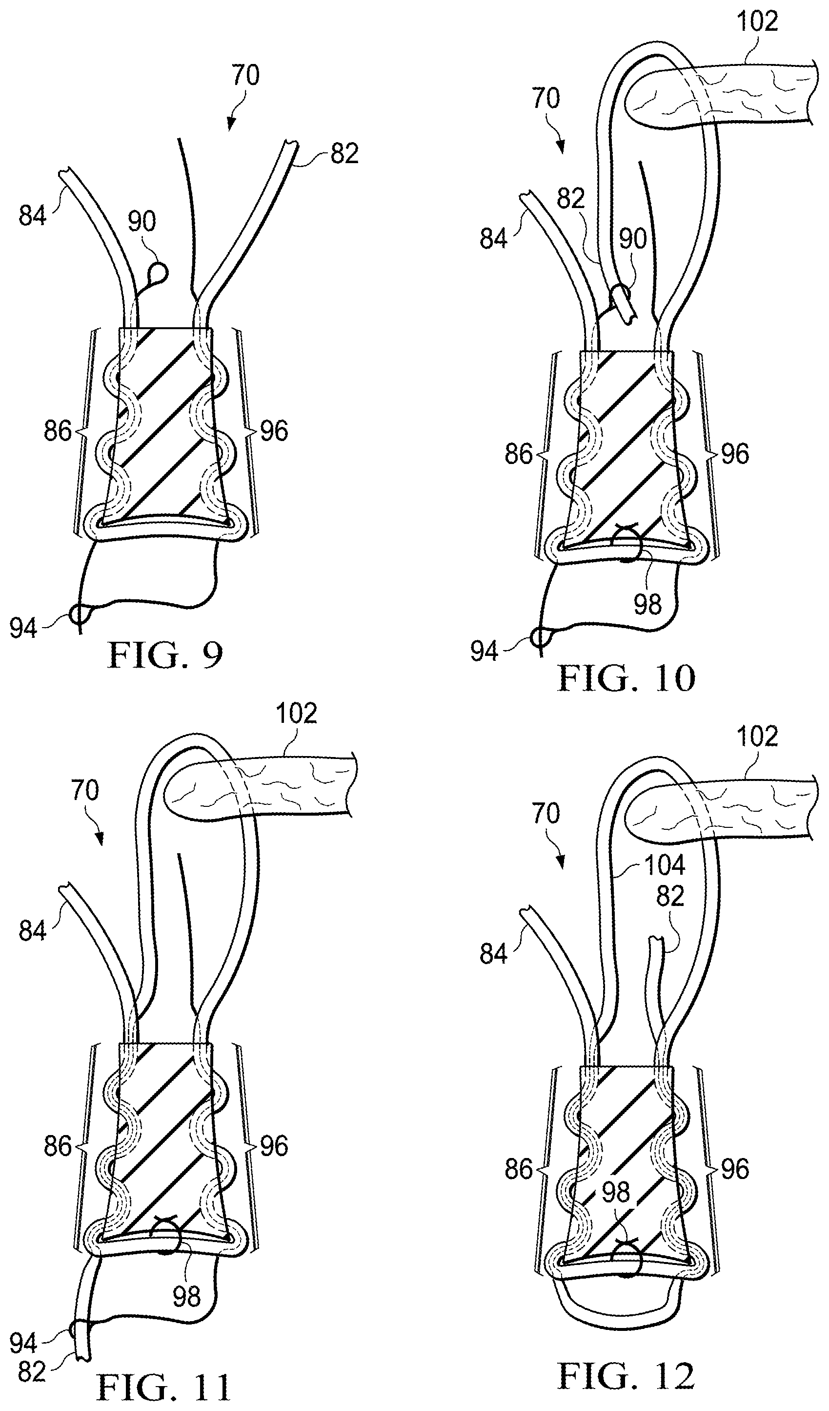 Patent US11812941 Figure 3 – Knotless all suture tissue repair