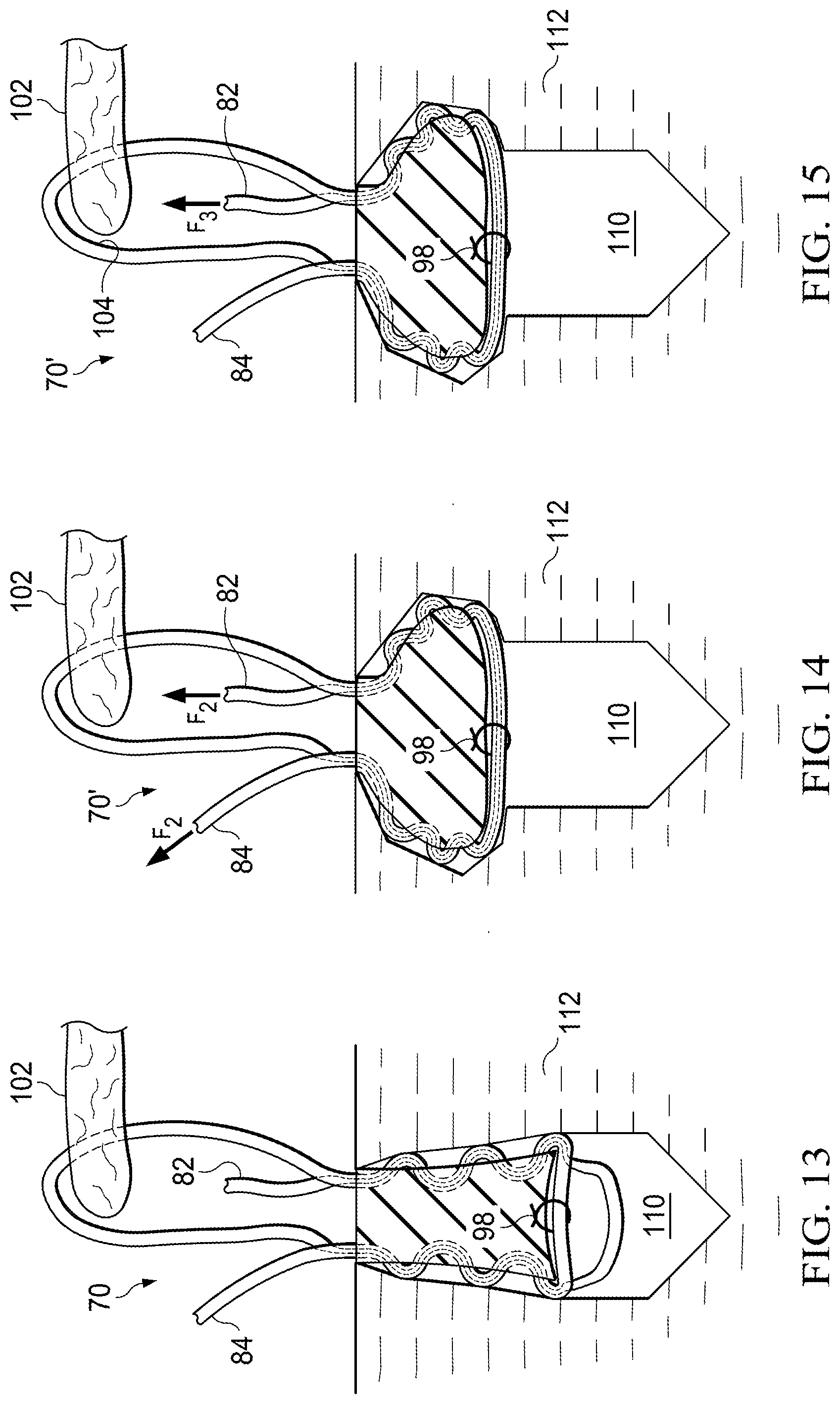 Patent US11812941 Figure 4 – Knotless all suture tissue repair