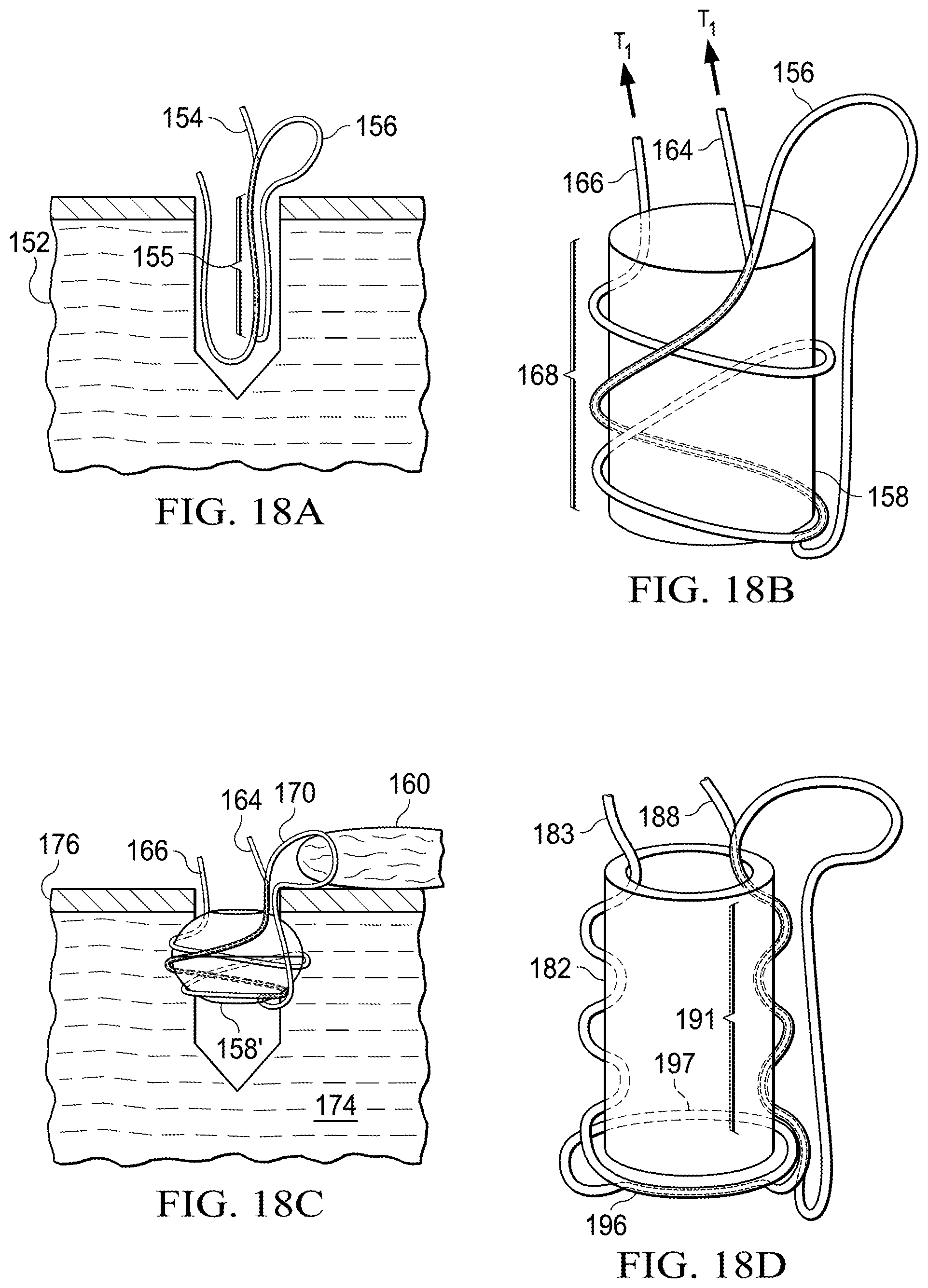 Patent US11812941 Figure 6 – Knotless all suture tissue repair