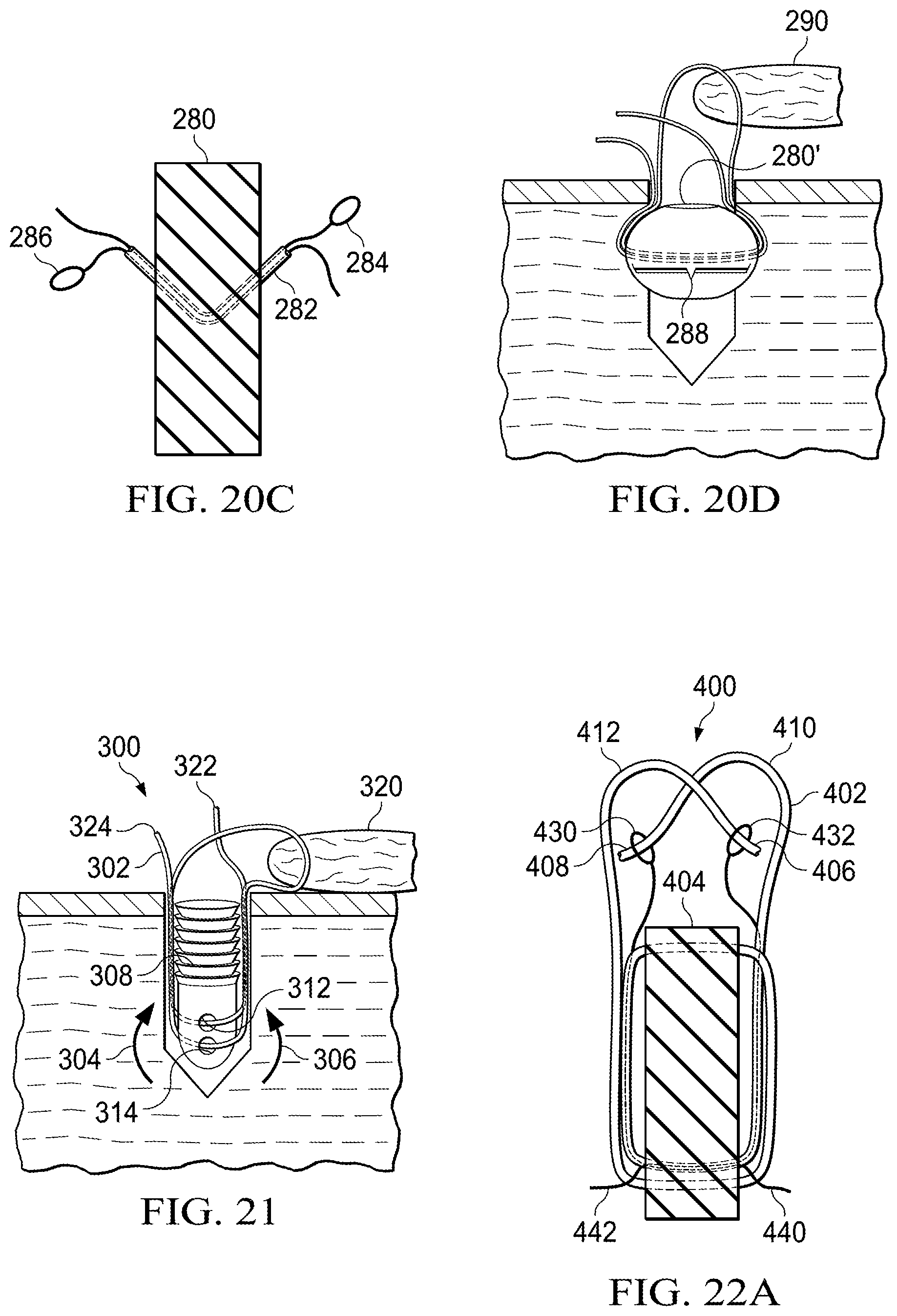 Patent US11812941 Figure 8 – Knotless all suture tissue repair