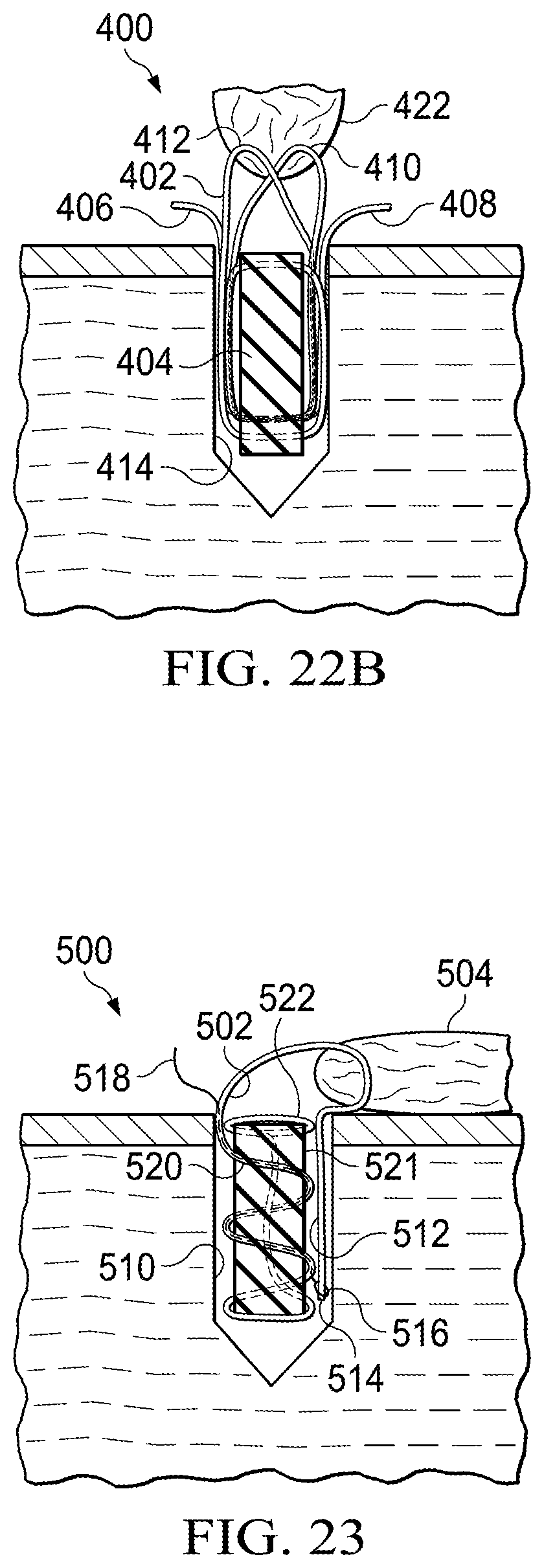 Patent US11812941 Figure 9 – Knotless all suture tissue repair