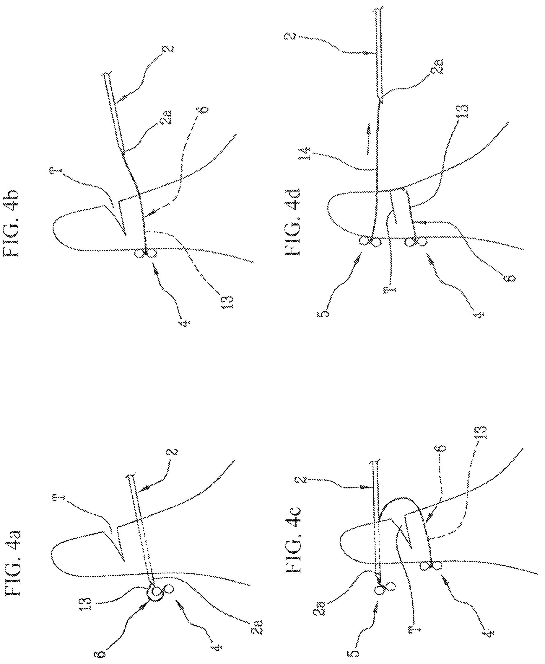 Patent US11812942 Figure 3 – Suturing device, in particular for suturing lacerations of the meniscus
