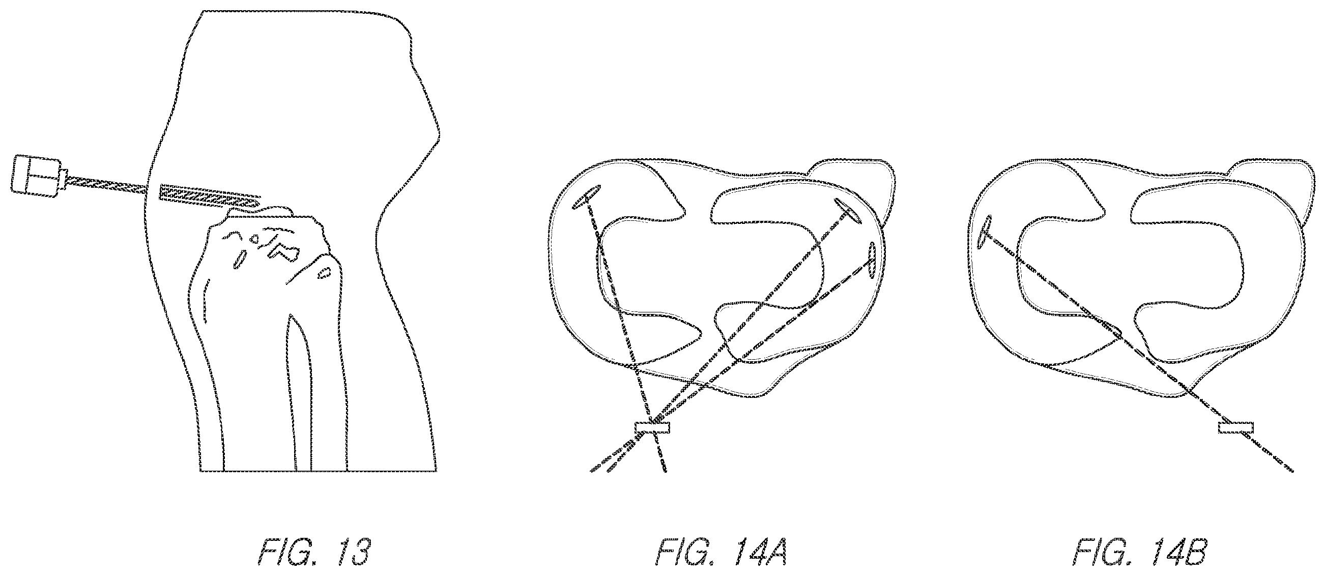 Patent US11812943 Figure 13 – Repair device and method for deploying anchors
