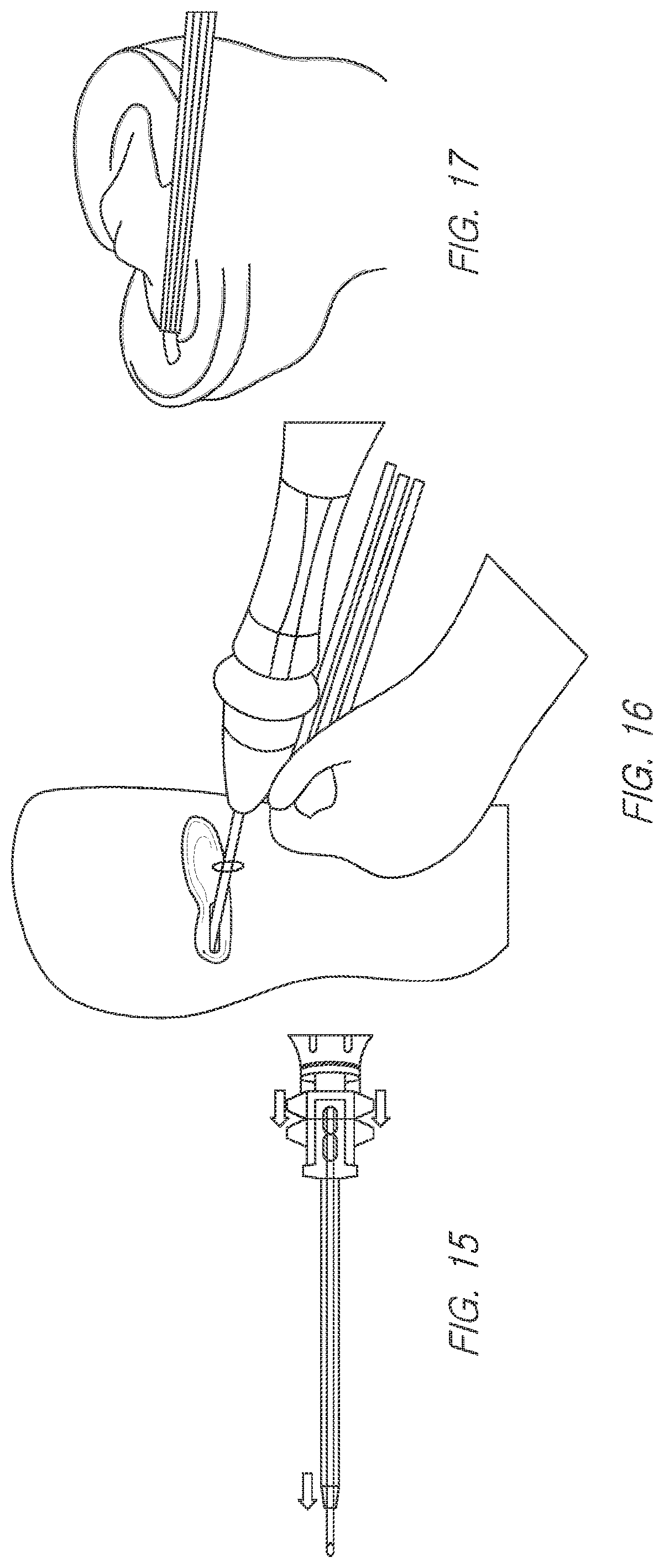 Patent US11812943 Figure 14 – Repair device and method for deploying anchors