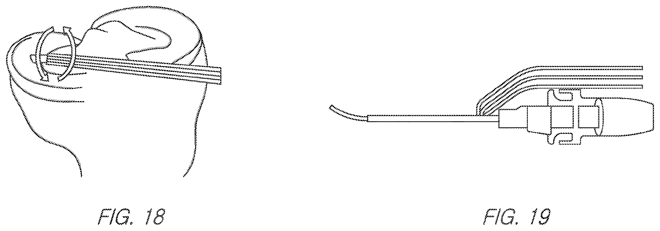 Patent US11812943 Figure 15 – Repair device and method for deploying anchors