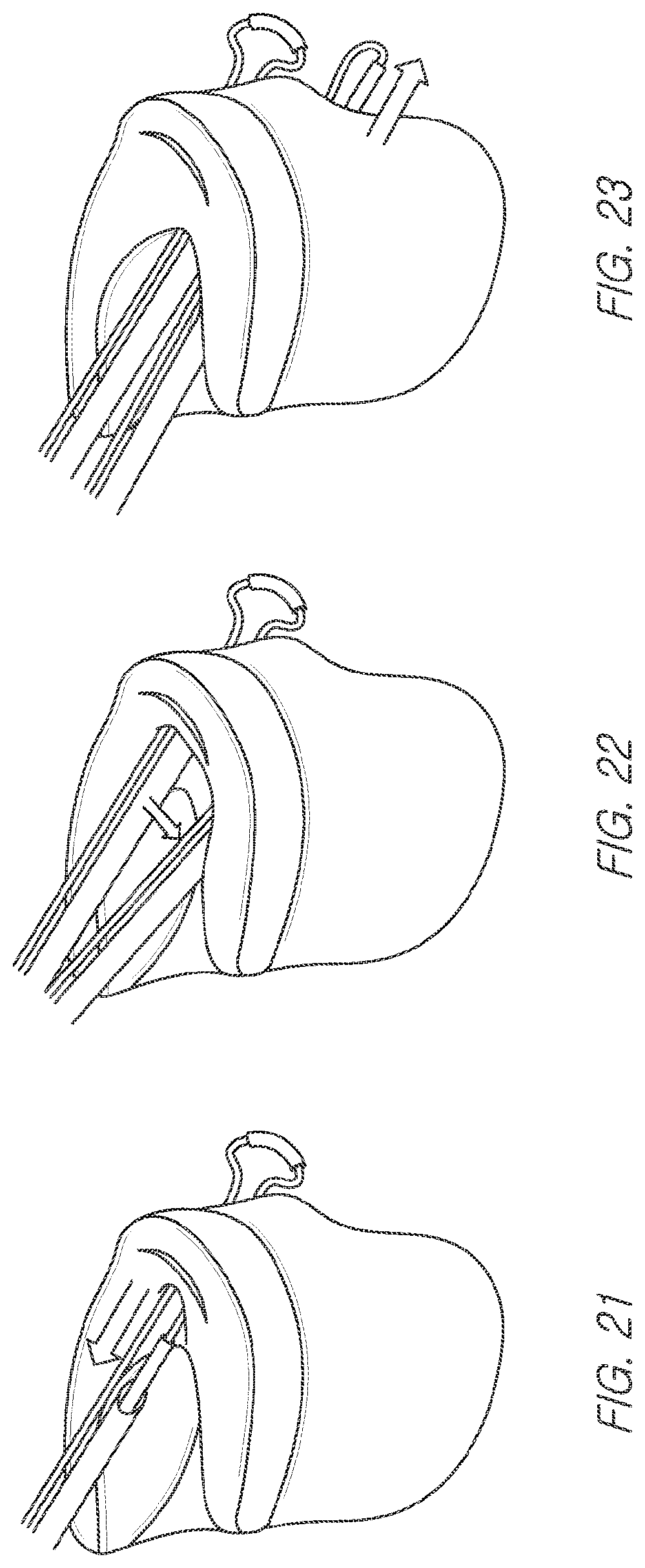 Patent US11812943 Figure 17 – Repair device and method for deploying anchors