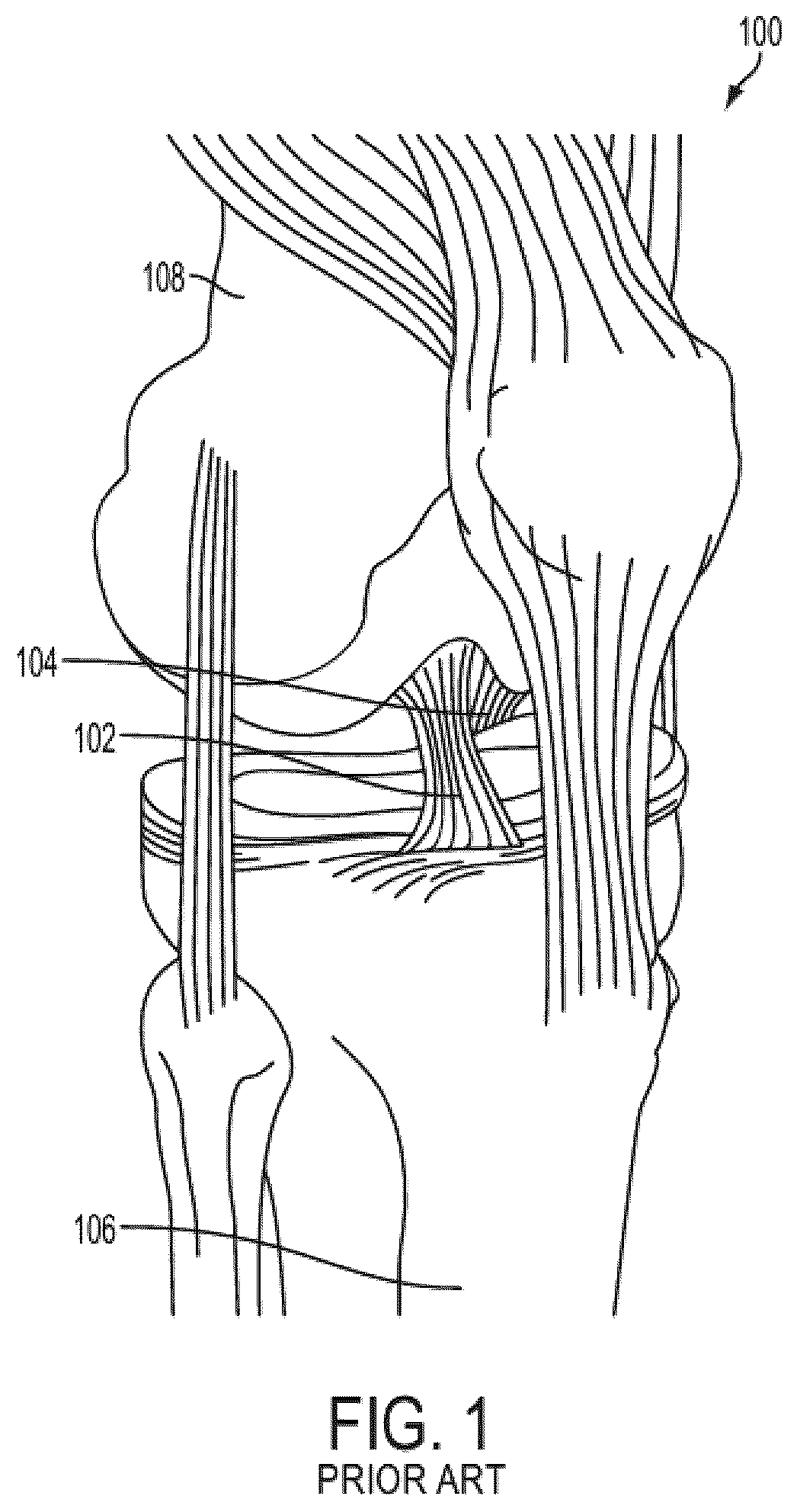 Patent US11812945 Figure 1 – One-way adjustable loop suture constructs and methods of forming and using the same