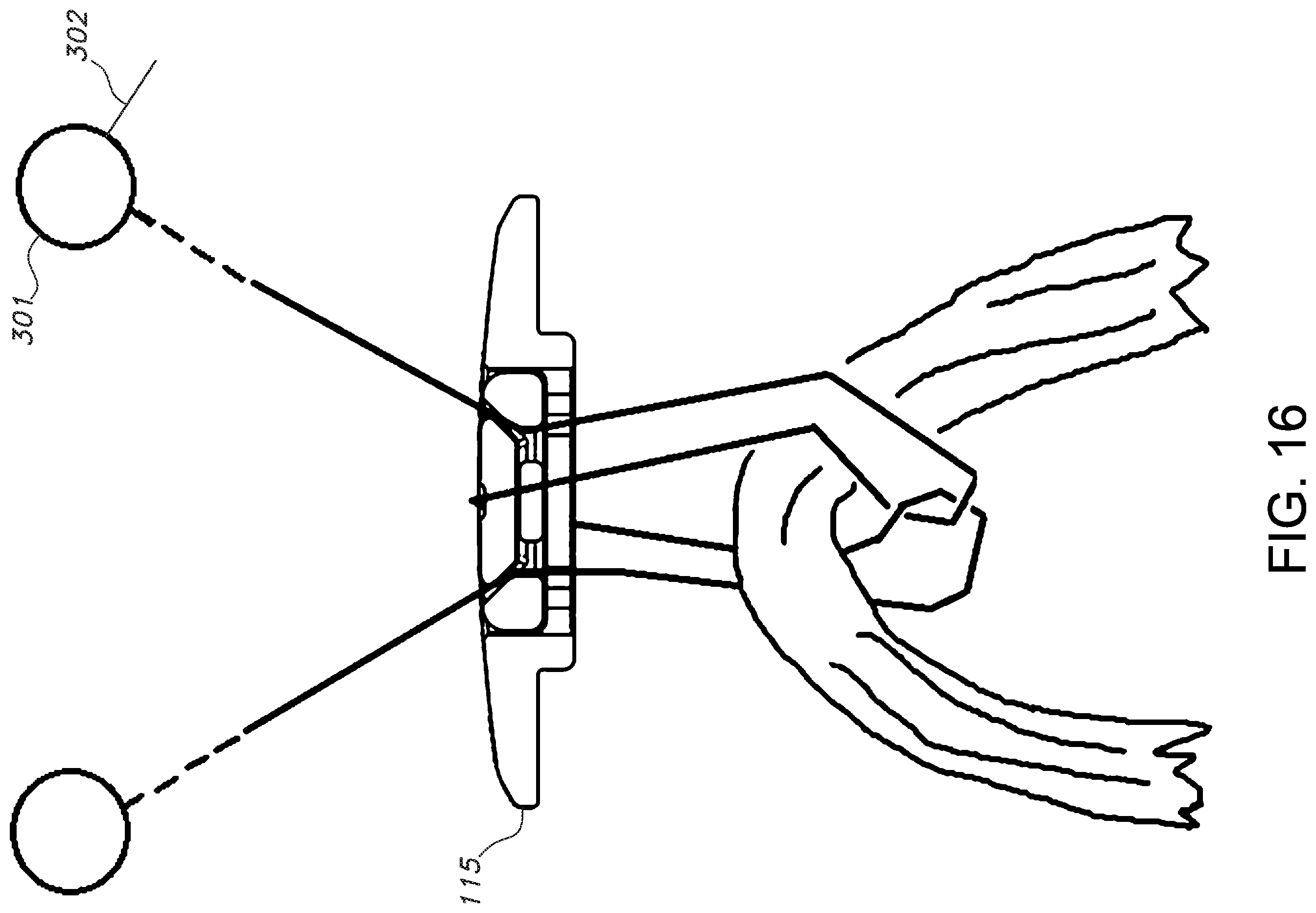 Patent US11812946 Figure 12 – Knotless orthopedic stabilization system