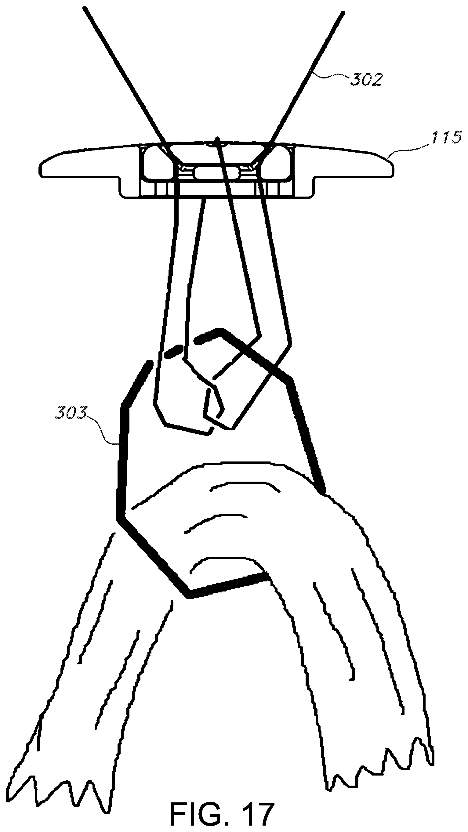 Patent US11812946 Figure 13 – Knotless orthopedic stabilization system