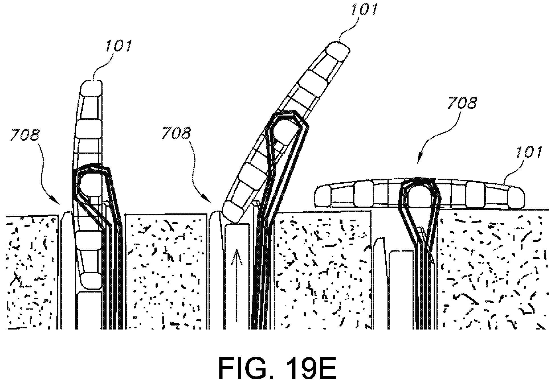 Patent US11812946 Figure 16 – Knotless orthopedic stabilization system