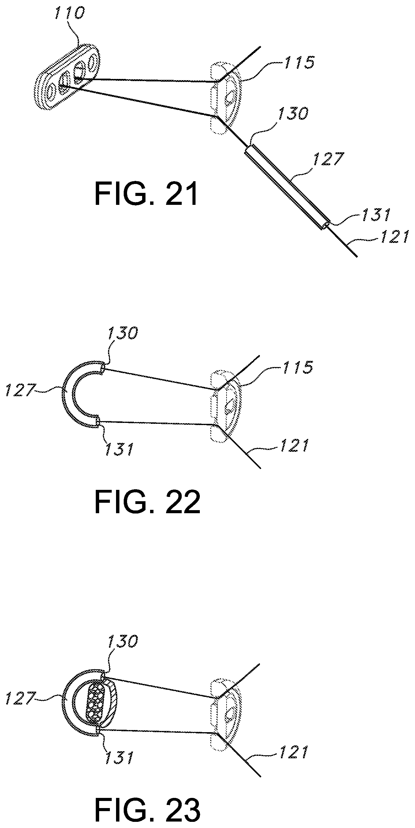 Patent US11812946 Figure 18 – Knotless orthopedic stabilization system