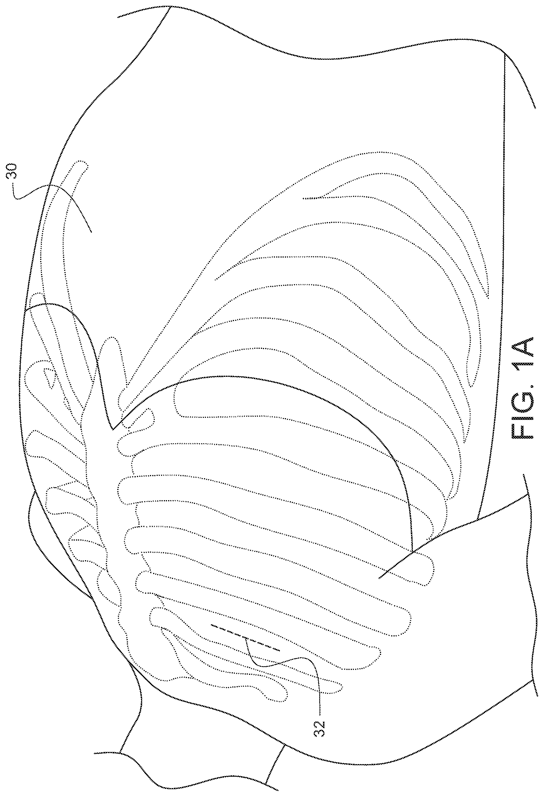 Patent US11812947 Figure 1 – Apparatus for suture management and methods thereof