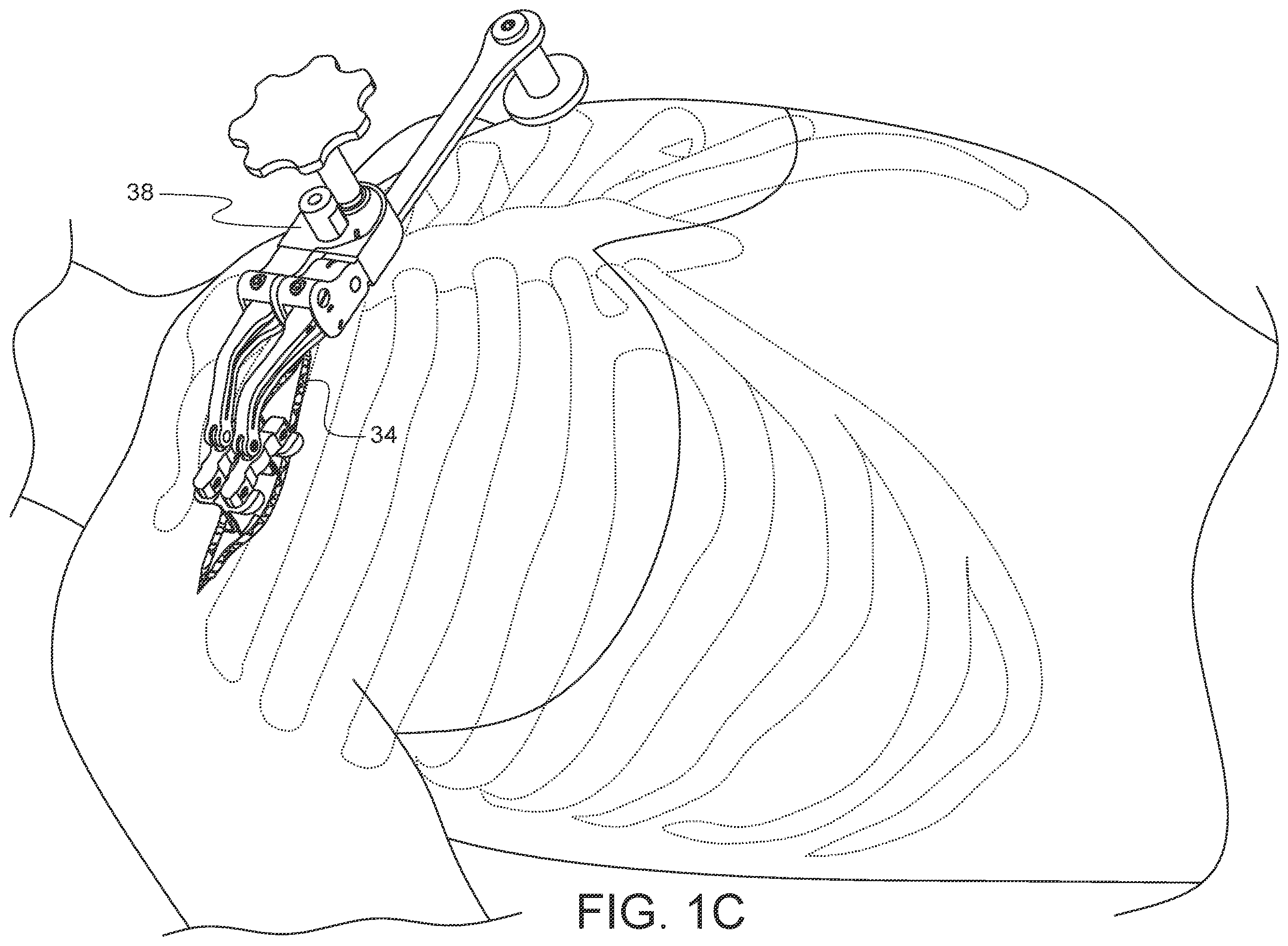 Patent US11812947 Figure 3 – Apparatus for suture management and methods thereof