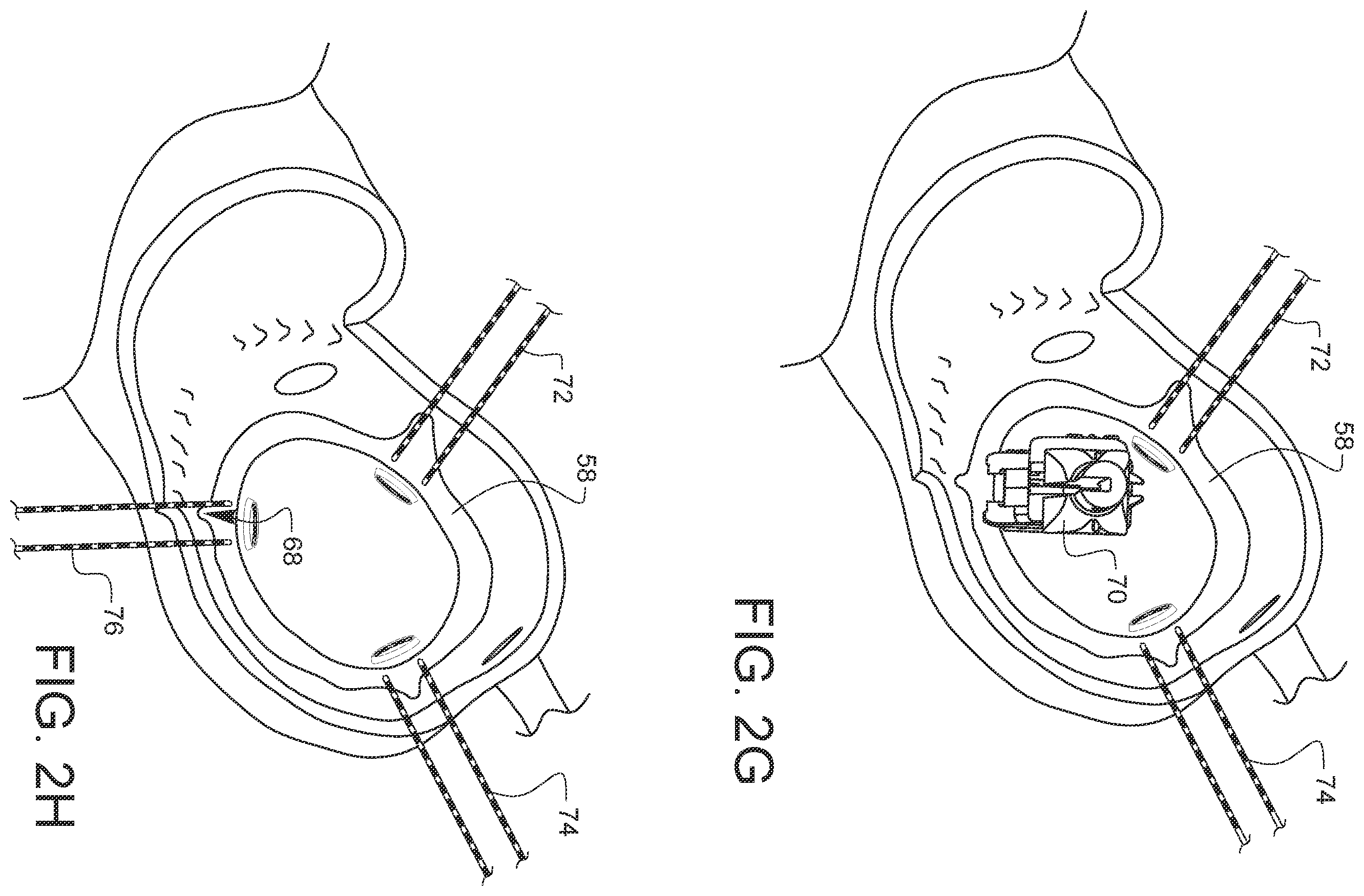 Patent US11812947 Figure 11 – Apparatus for suture management and methods thereof