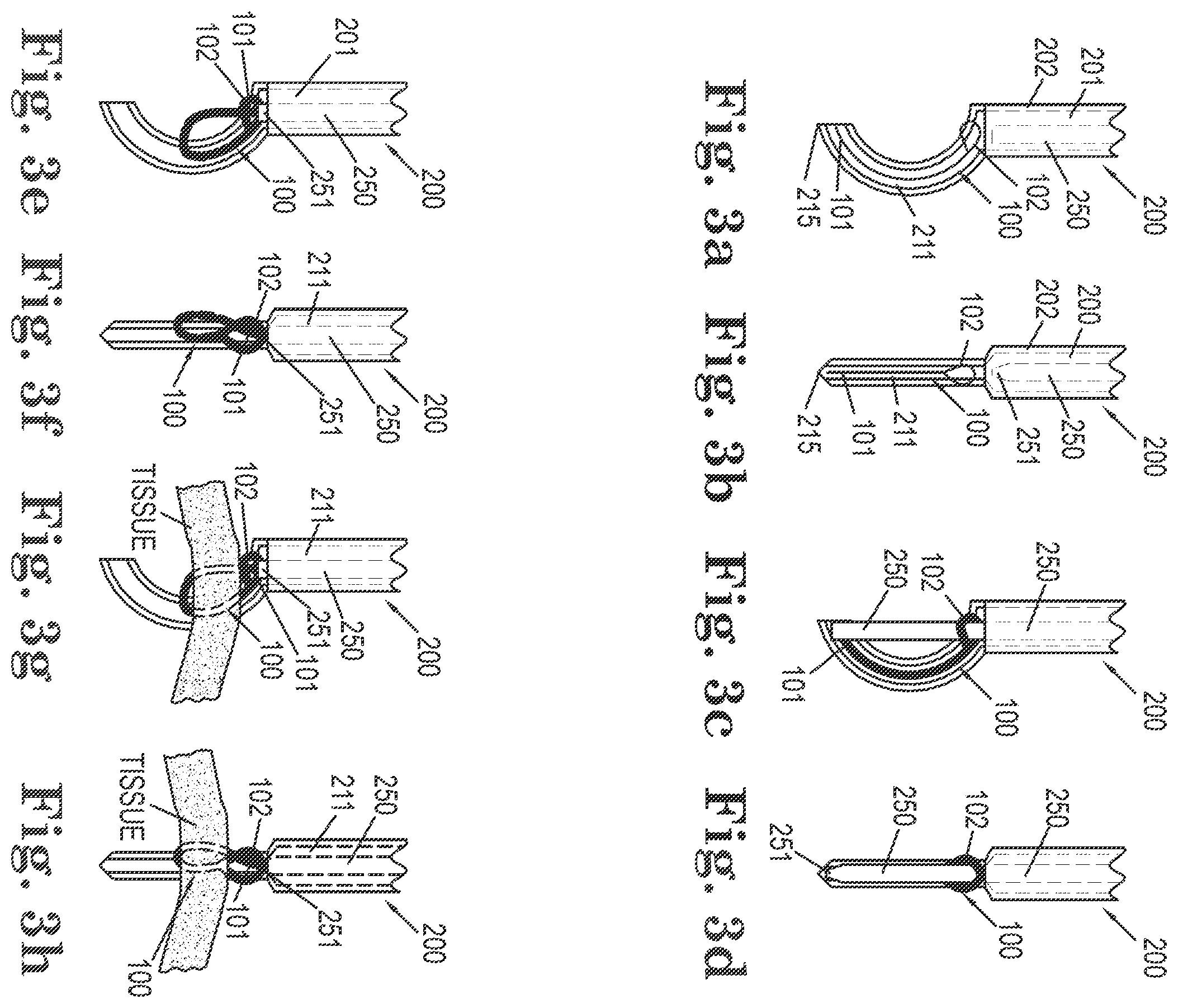 Patent US11812949 Figure 2 – Filamentous tissue implant