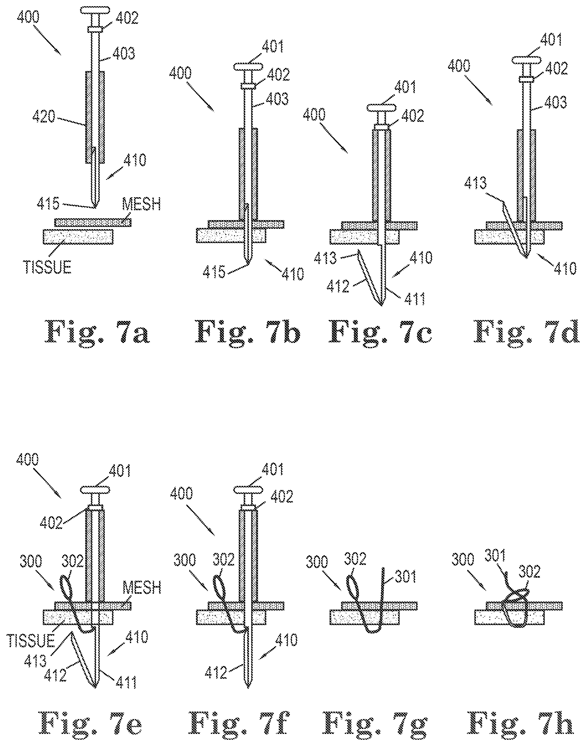 Patent US11812949 Figure 5 – Filamentous tissue implant