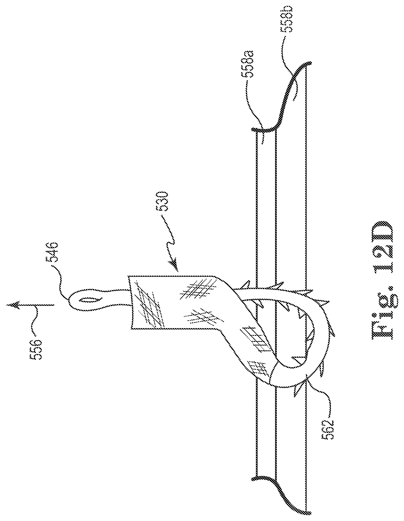 Patent US11812949 Figure 9 – Filamentous tissue implant
