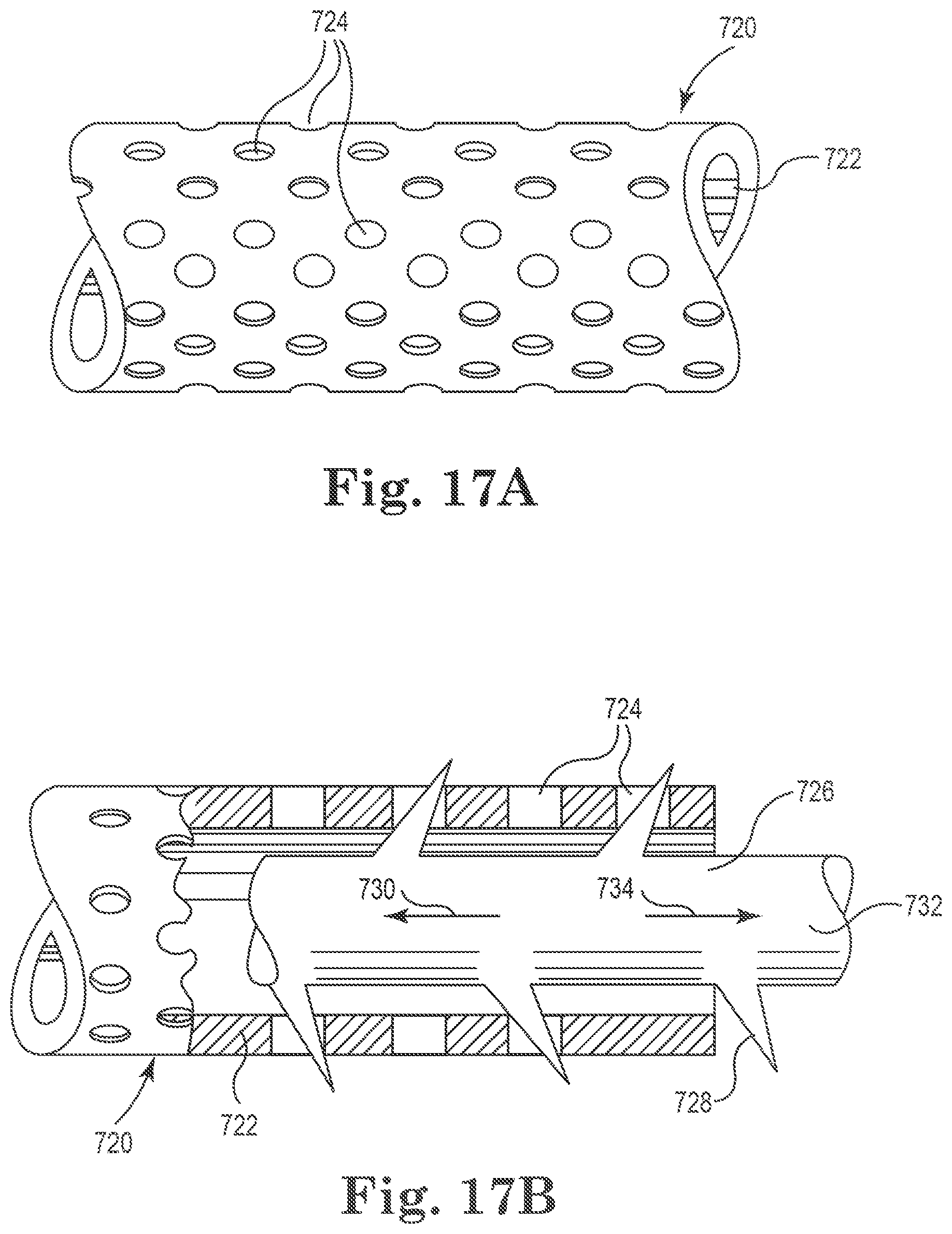 Patent US11812949 Figure 13 – Filamentous tissue implant