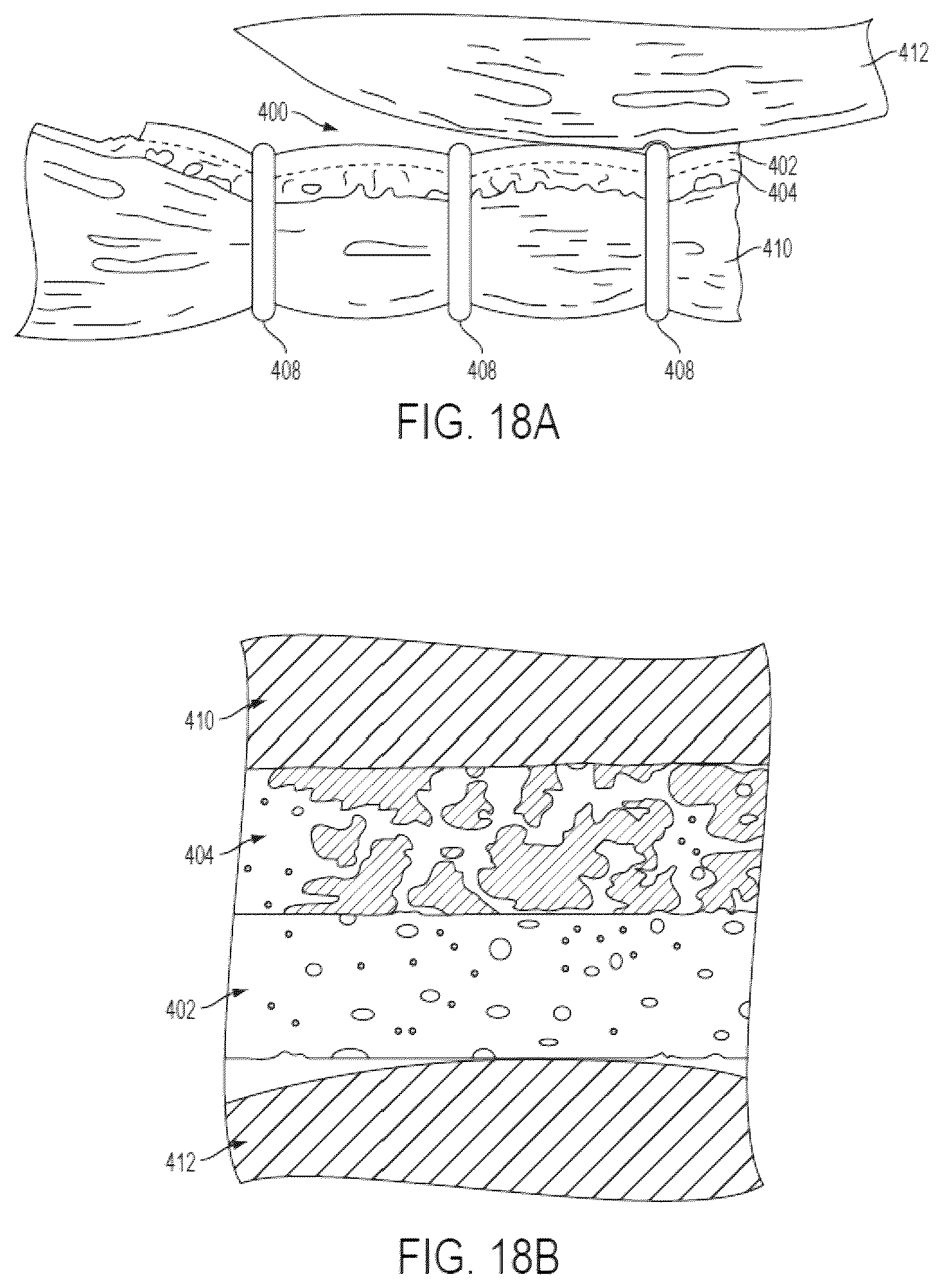 Patent US11812953 Figure 11 – Tissue ingrowth materials and method of using the same