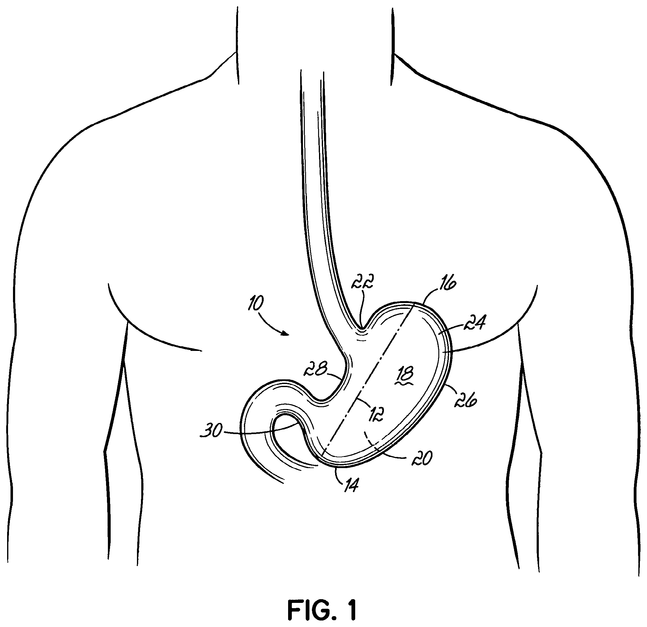 Patent US11812962 Figure 1 – End effectors, surgical stapling devices, and methods of using same