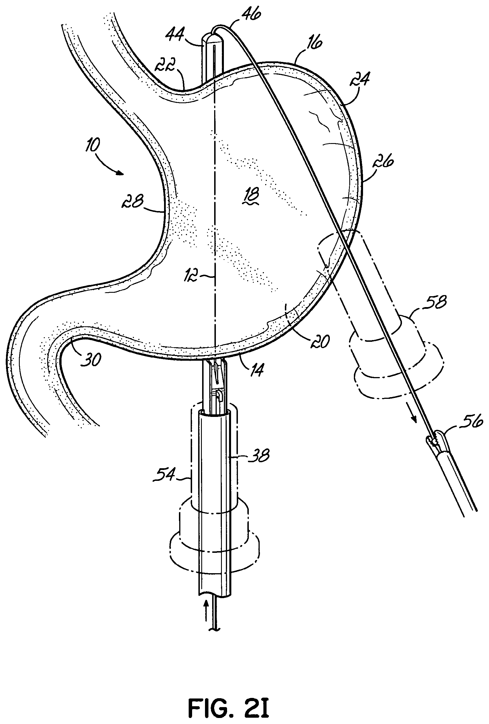 Patent US11812962 Figure 9 – End effectors, surgical stapling devices, and methods of using same