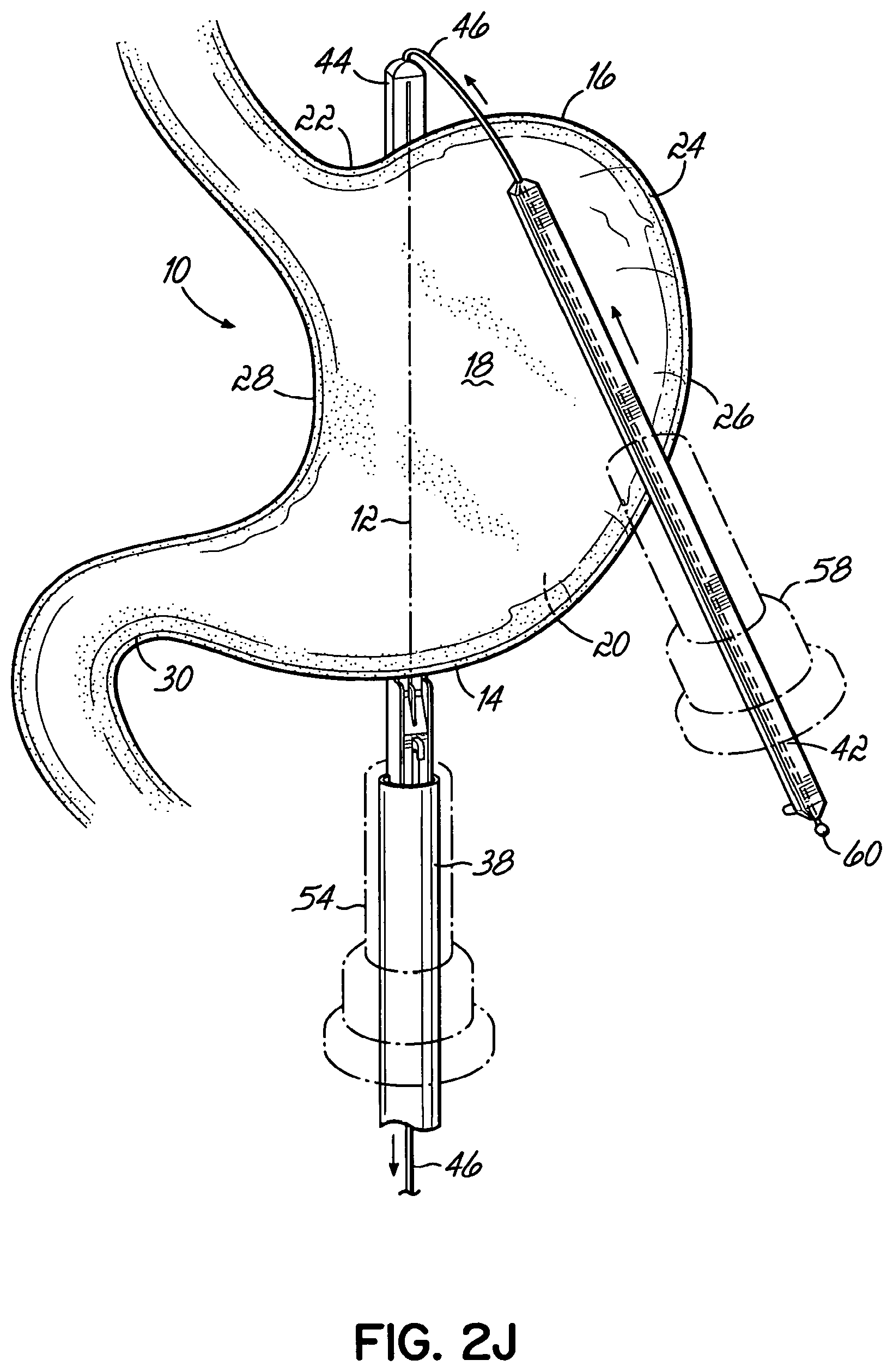 Patent US11812962 Figure 10 – End effectors, surgical stapling devices, and methods of using same