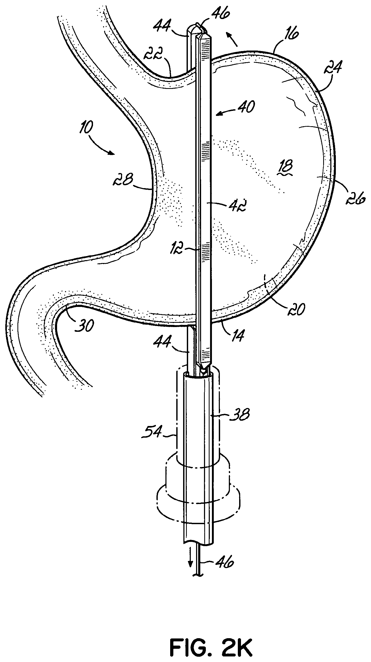 Patent US11812962 Figure 11 – End effectors, surgical stapling devices, and methods of using same