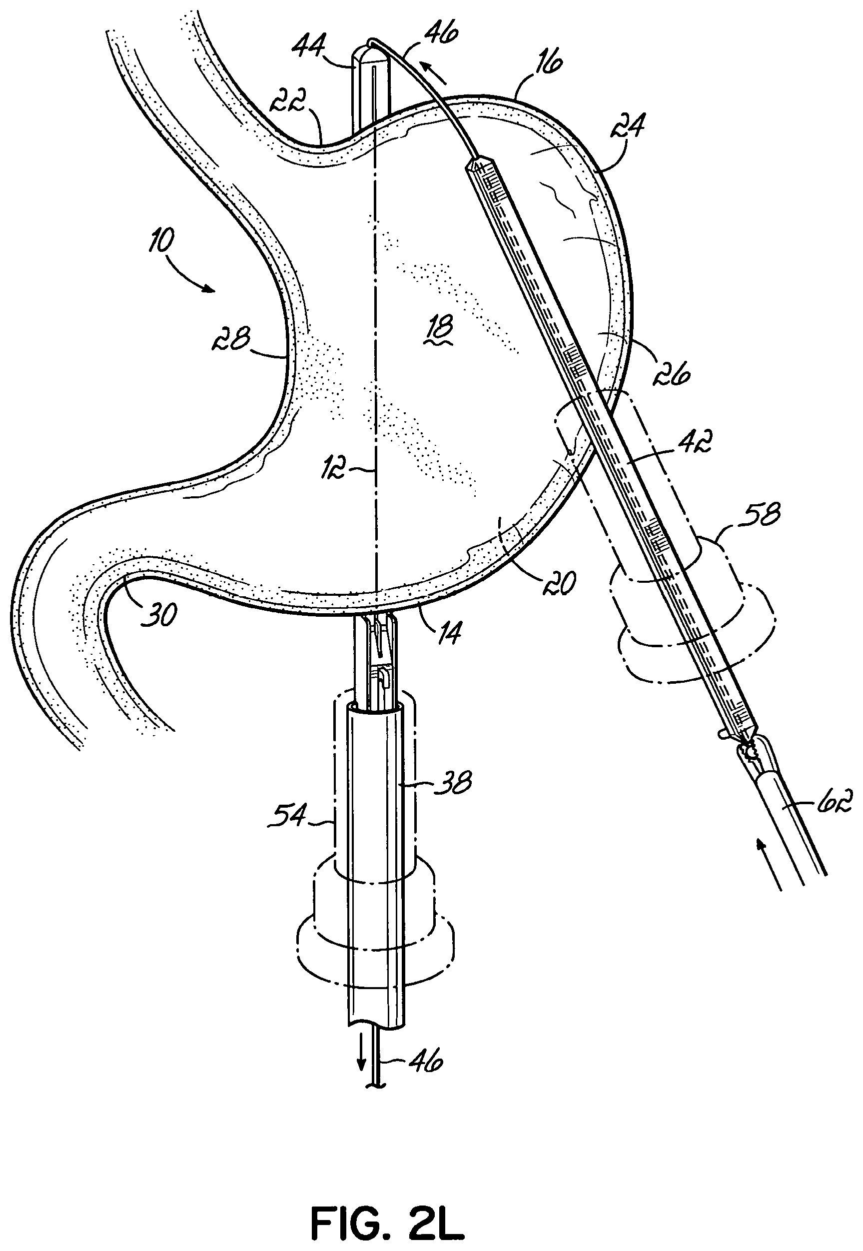 Patent US11812962 Figure 12 – End effectors, surgical stapling devices, and methods of using same
