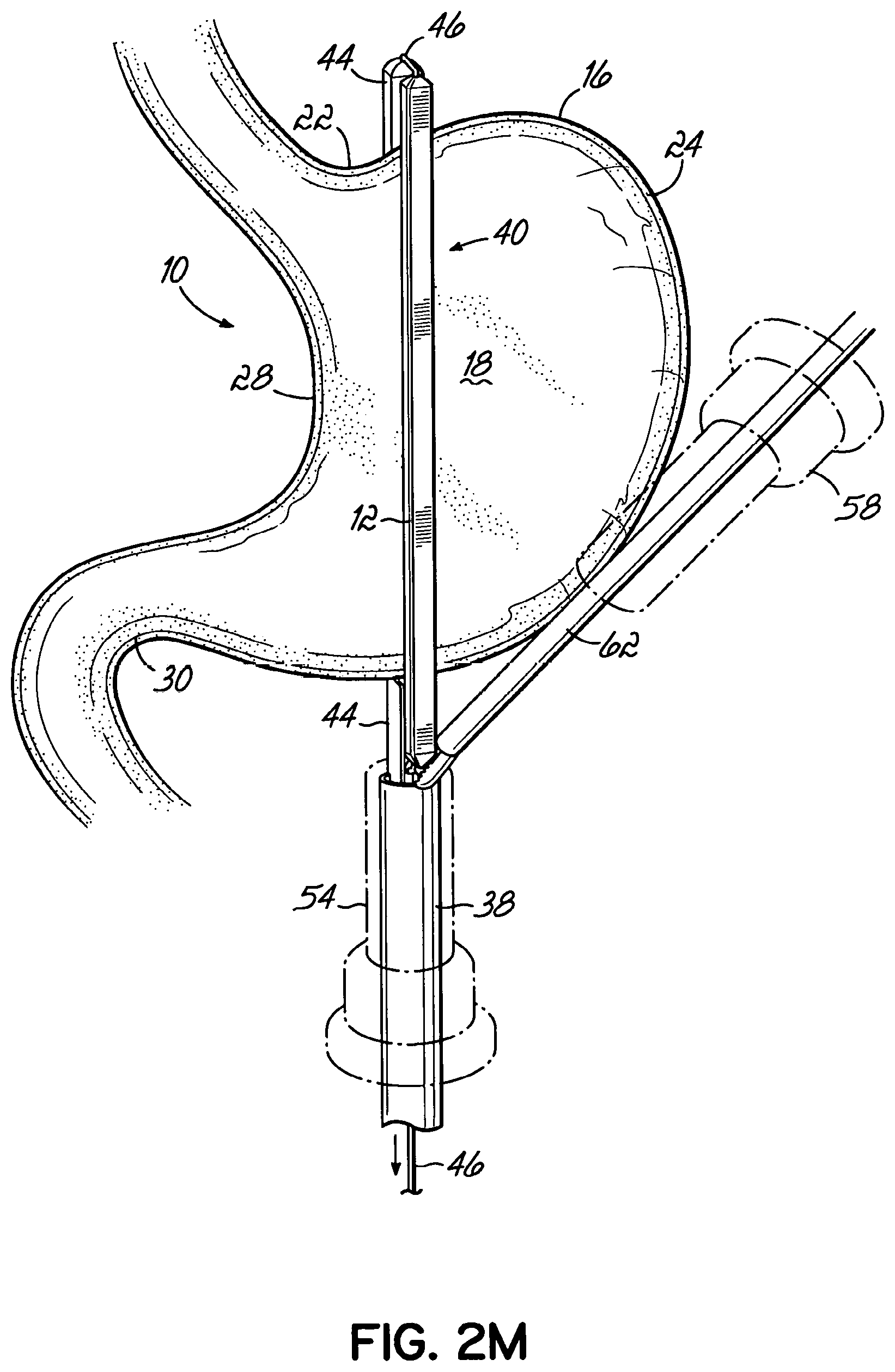 Patent US11812962 Figure 13 – End effectors, surgical stapling devices, and methods of using same