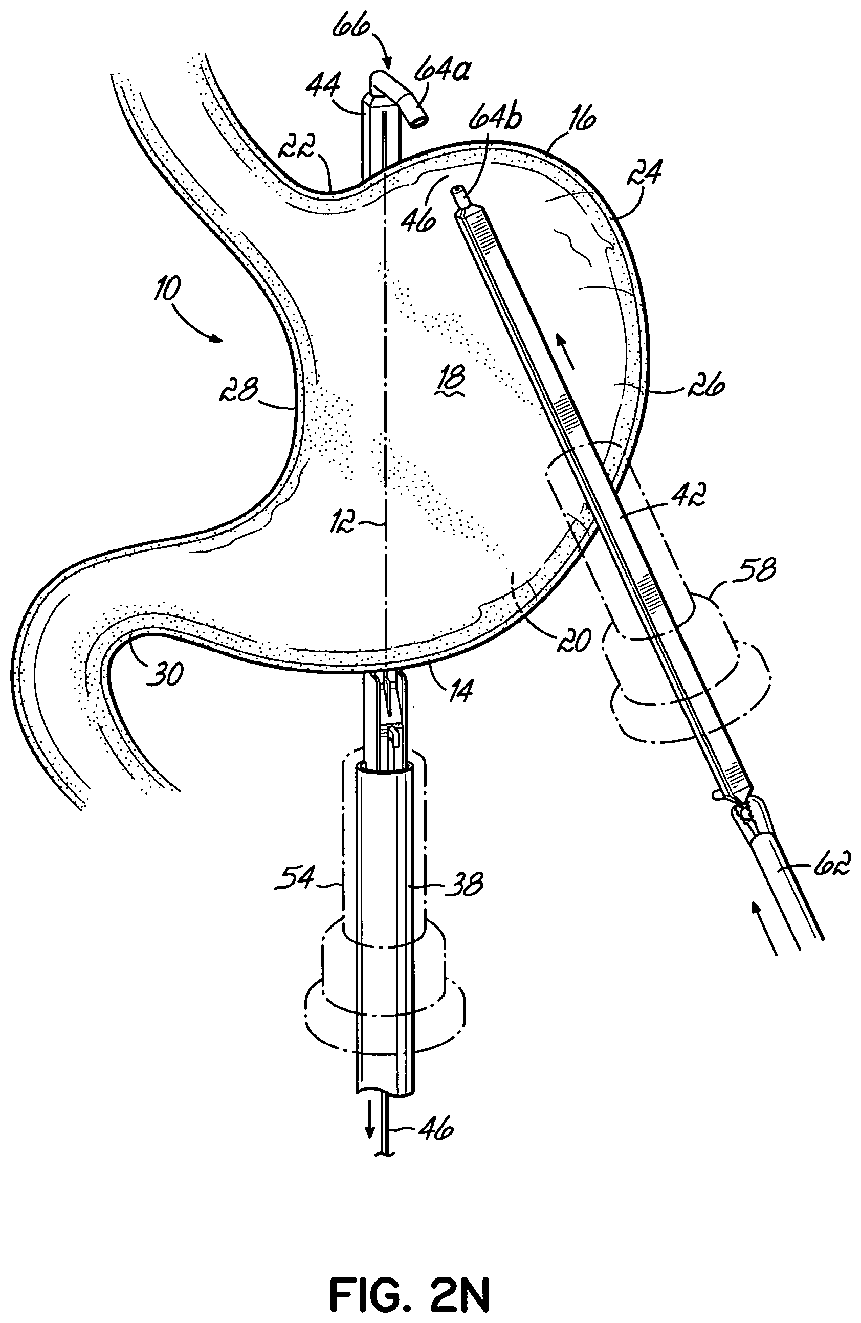 Patent US11812962 Figure 14 – End effectors, surgical stapling devices, and methods of using same