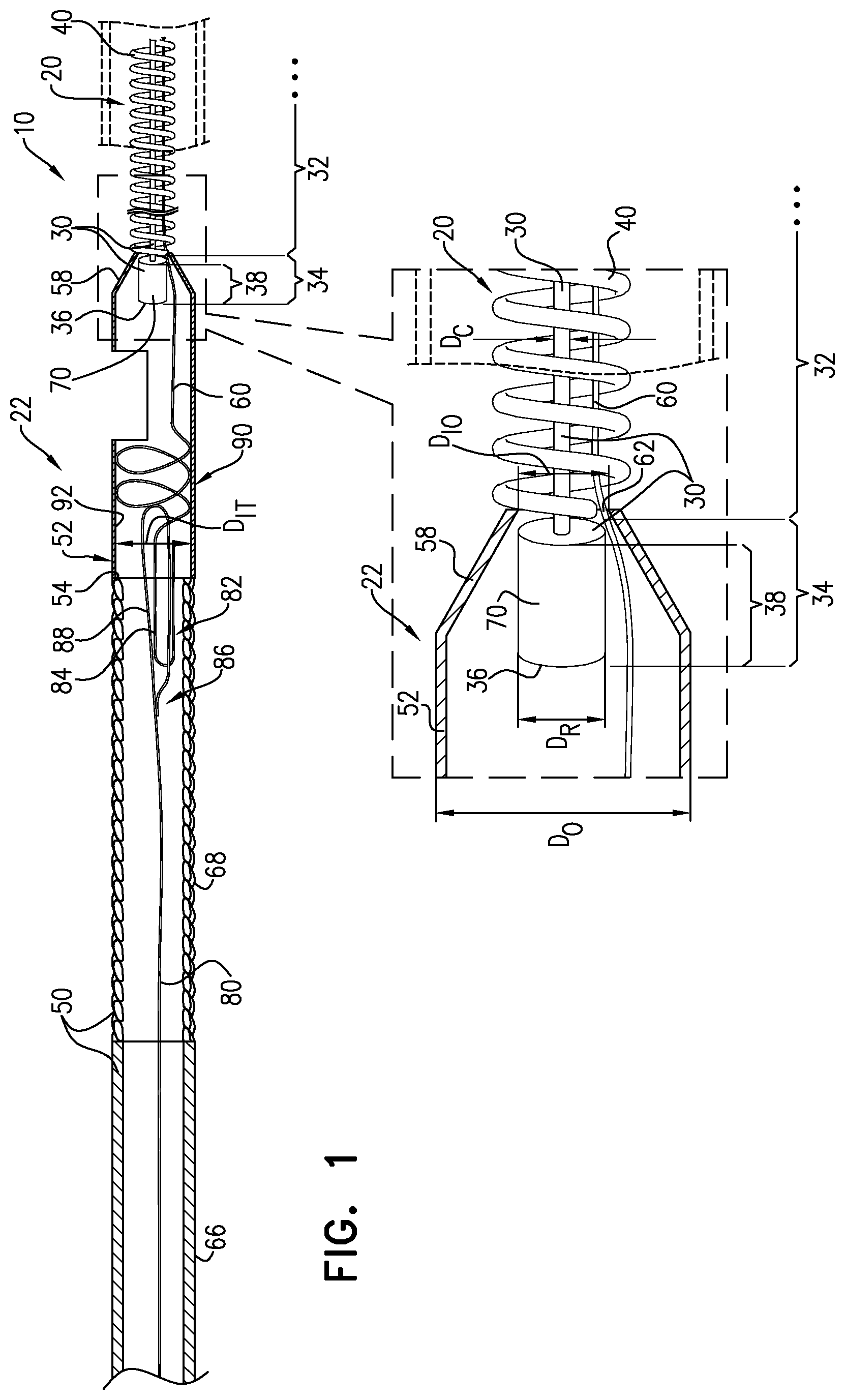 Patent US11812970 Figure 1 – Vascular-malformation implant system