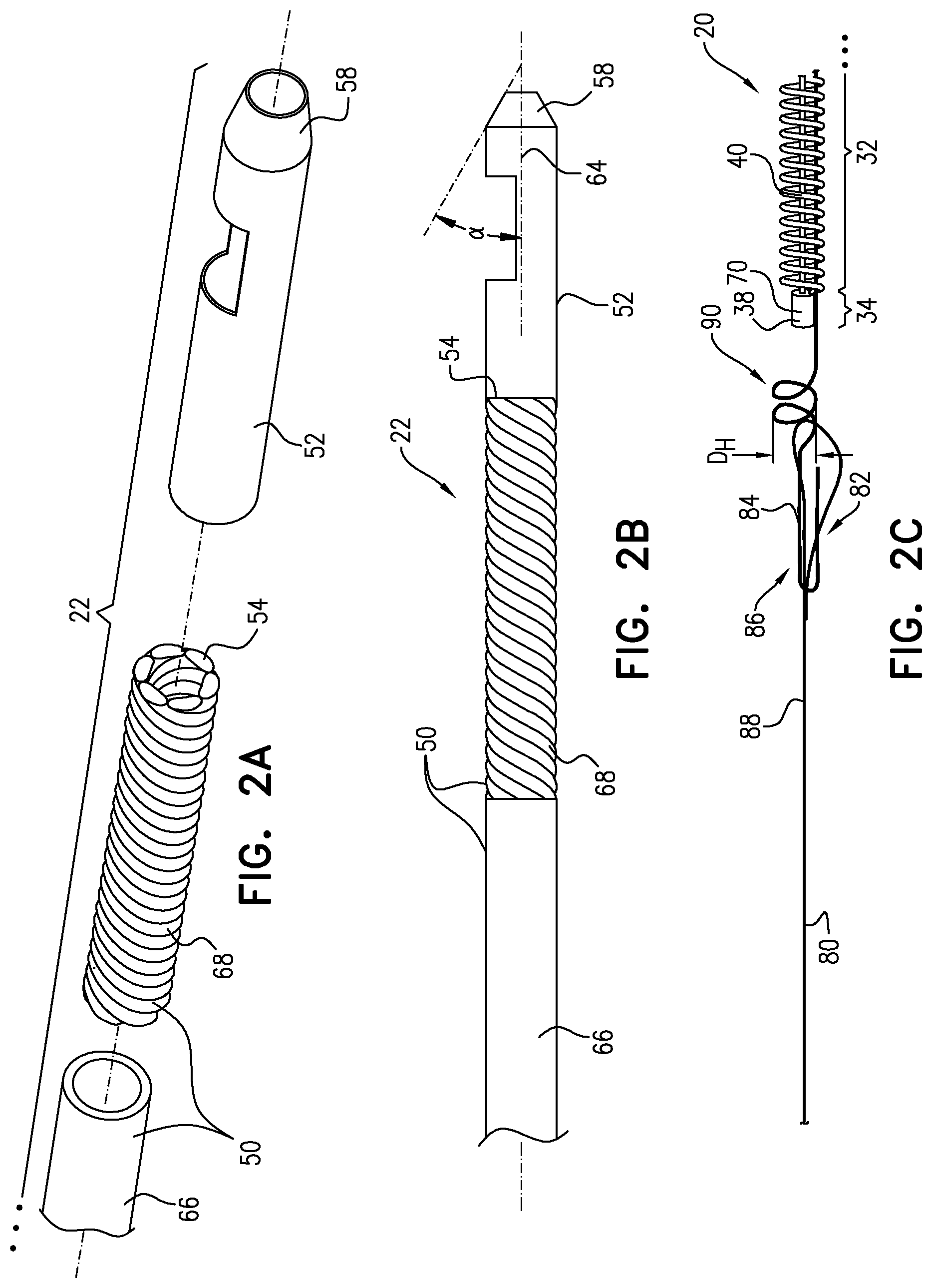 Patent US11812970 Figure 2 – Vascular-malformation implant system