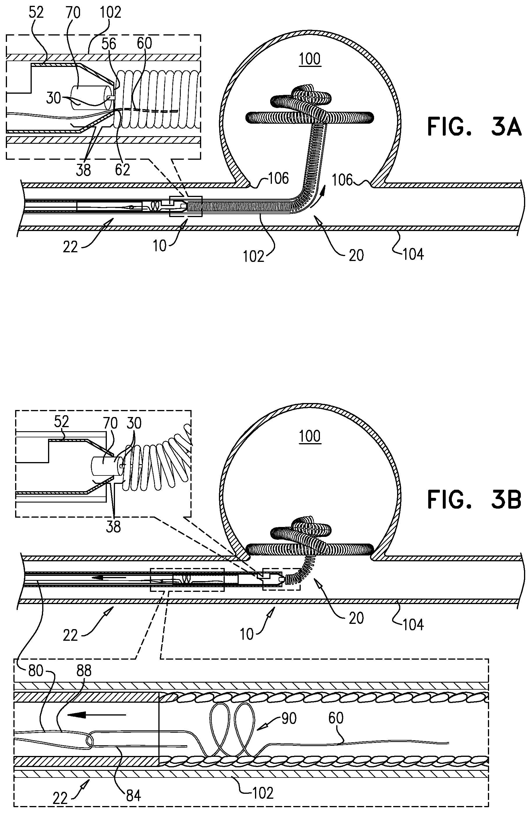 Patent US11812970 Figure 3 – Vascular-malformation implant system