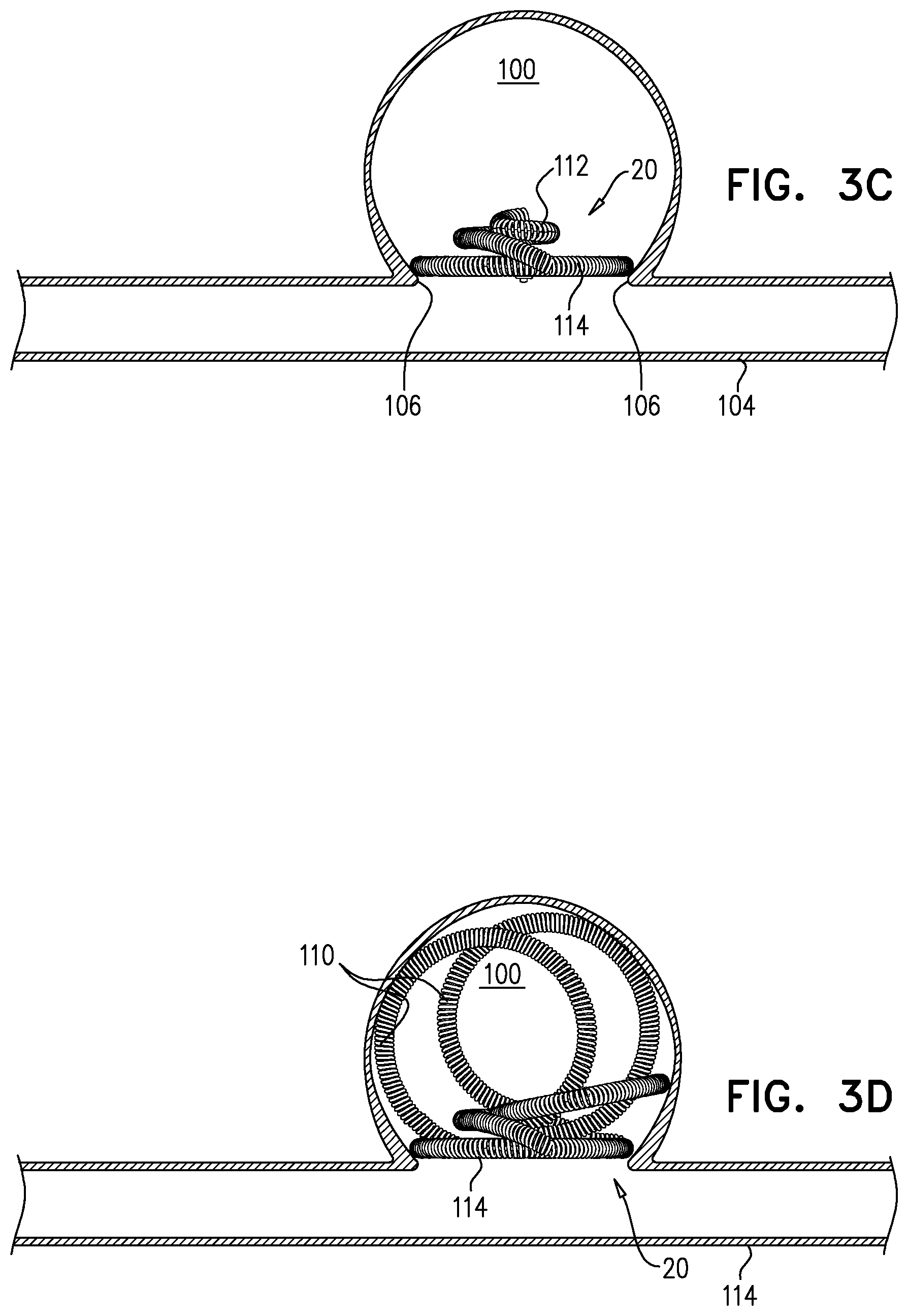 Patent US11812970 Figure 4 – Vascular-malformation implant system