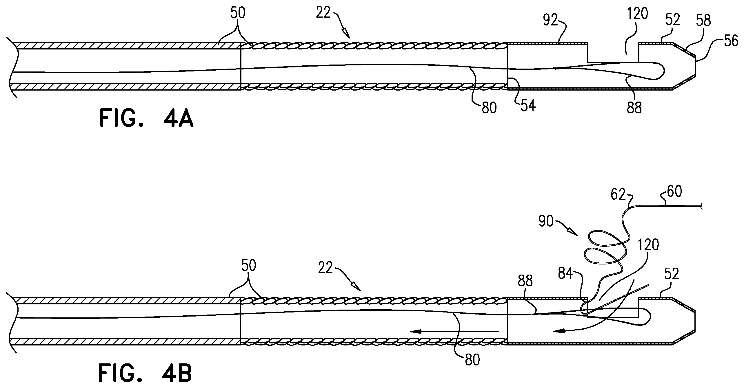 Patent US11812970 Figure 5 – Vascular-malformation implant system