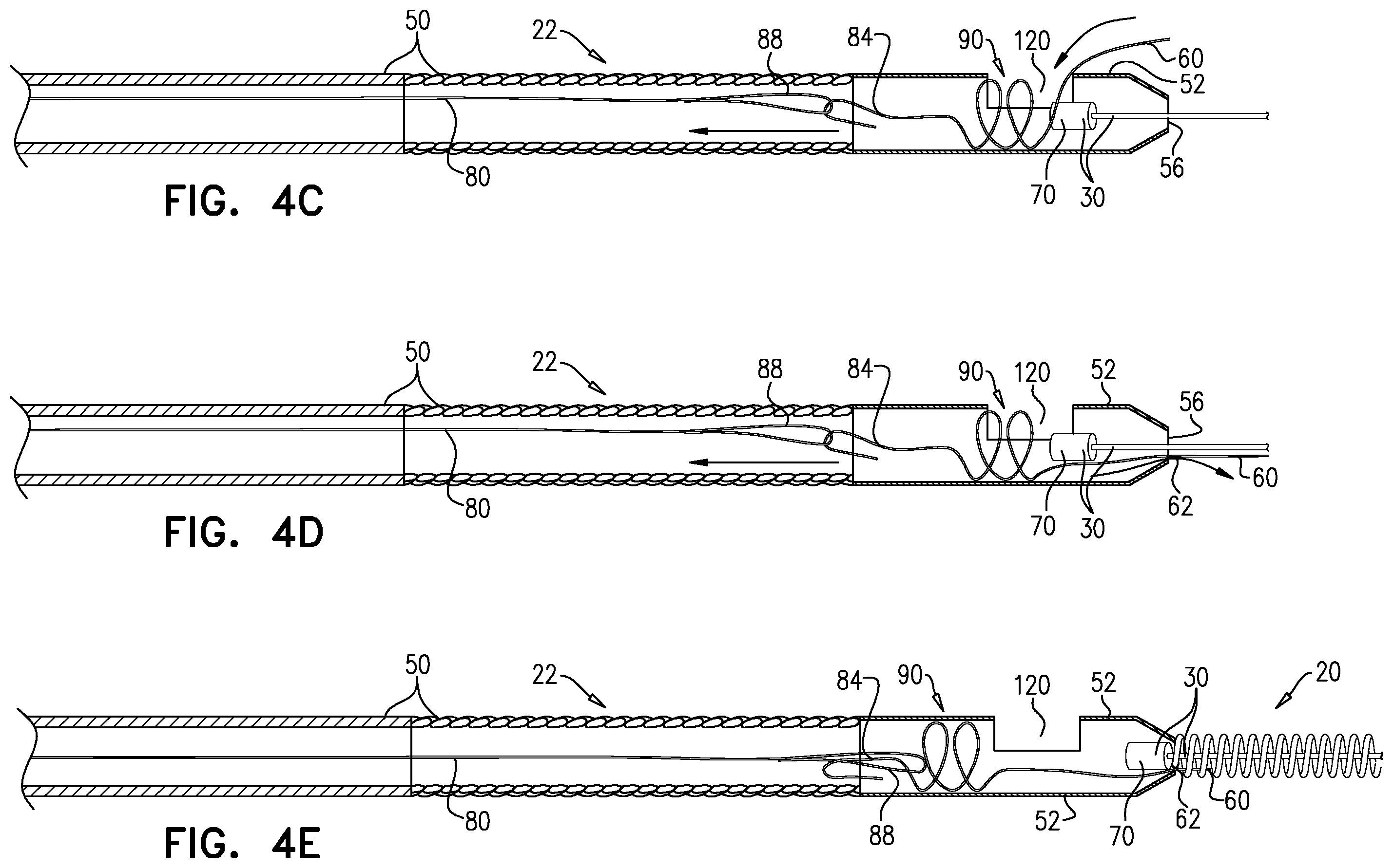 Patent US11812970 Figure 6 – Vascular-malformation implant system
