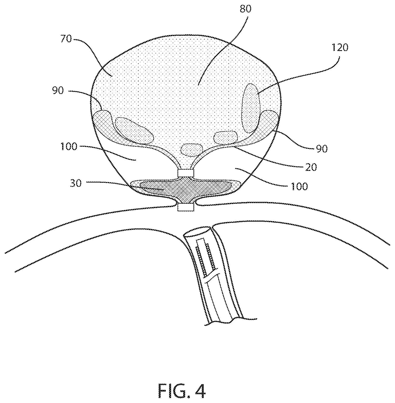Patent US11812971 Figure 3 – Occlusion device