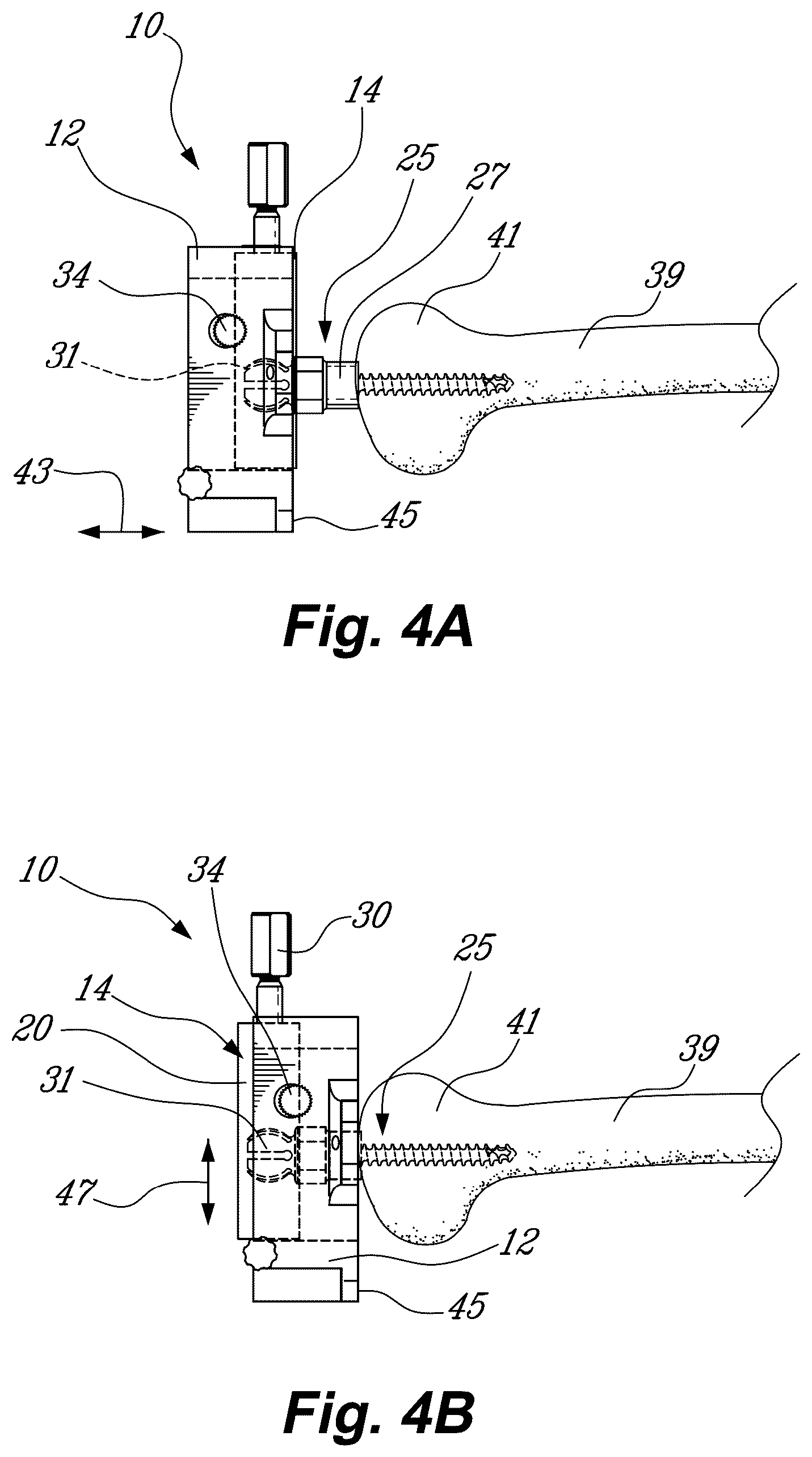 Patent US11812974 Figure 3 – Method and system for planning/guiding alterations to a bone