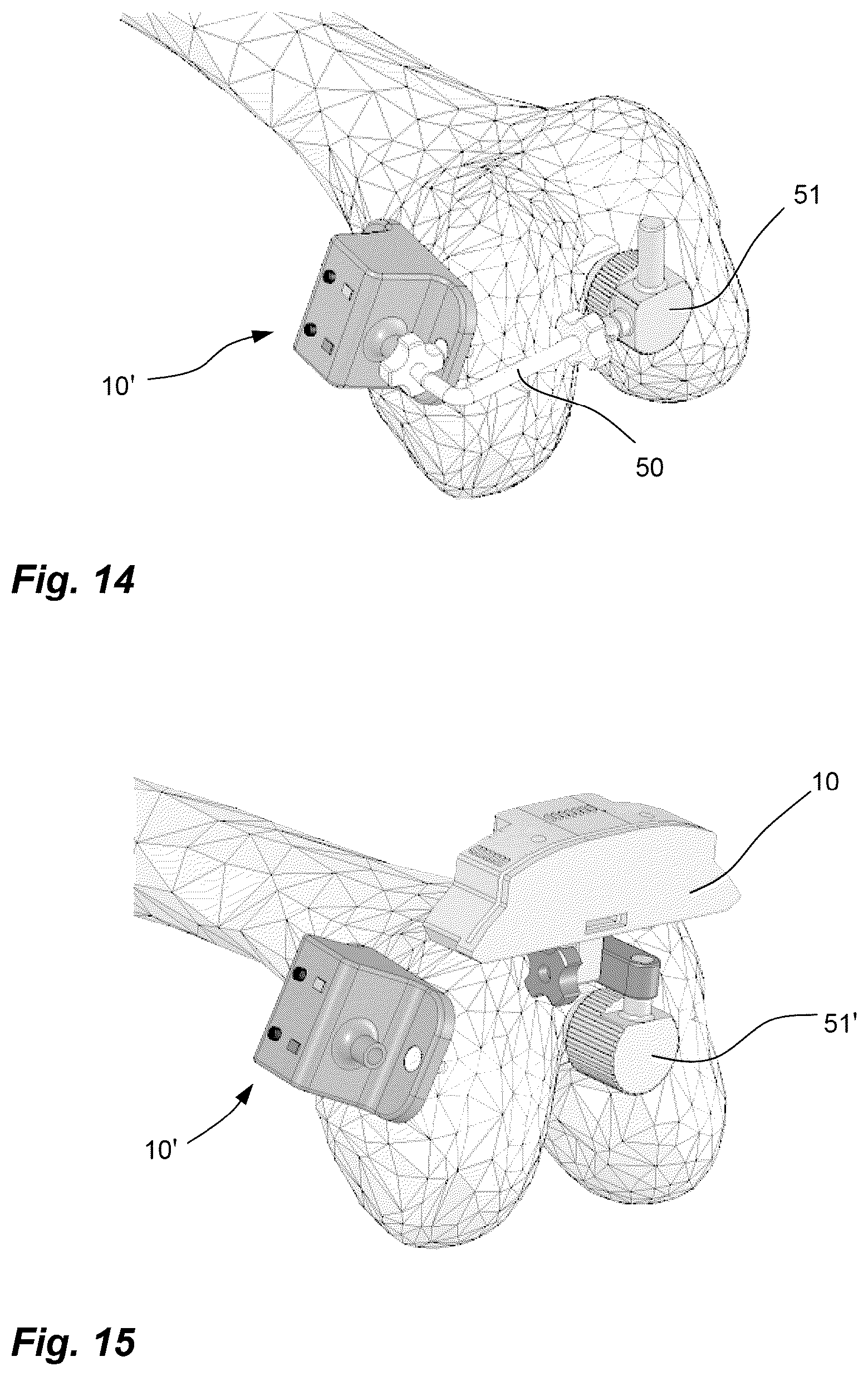 Patent US11812974 Figure 13 – Method and system for planning/guiding alterations to a bone